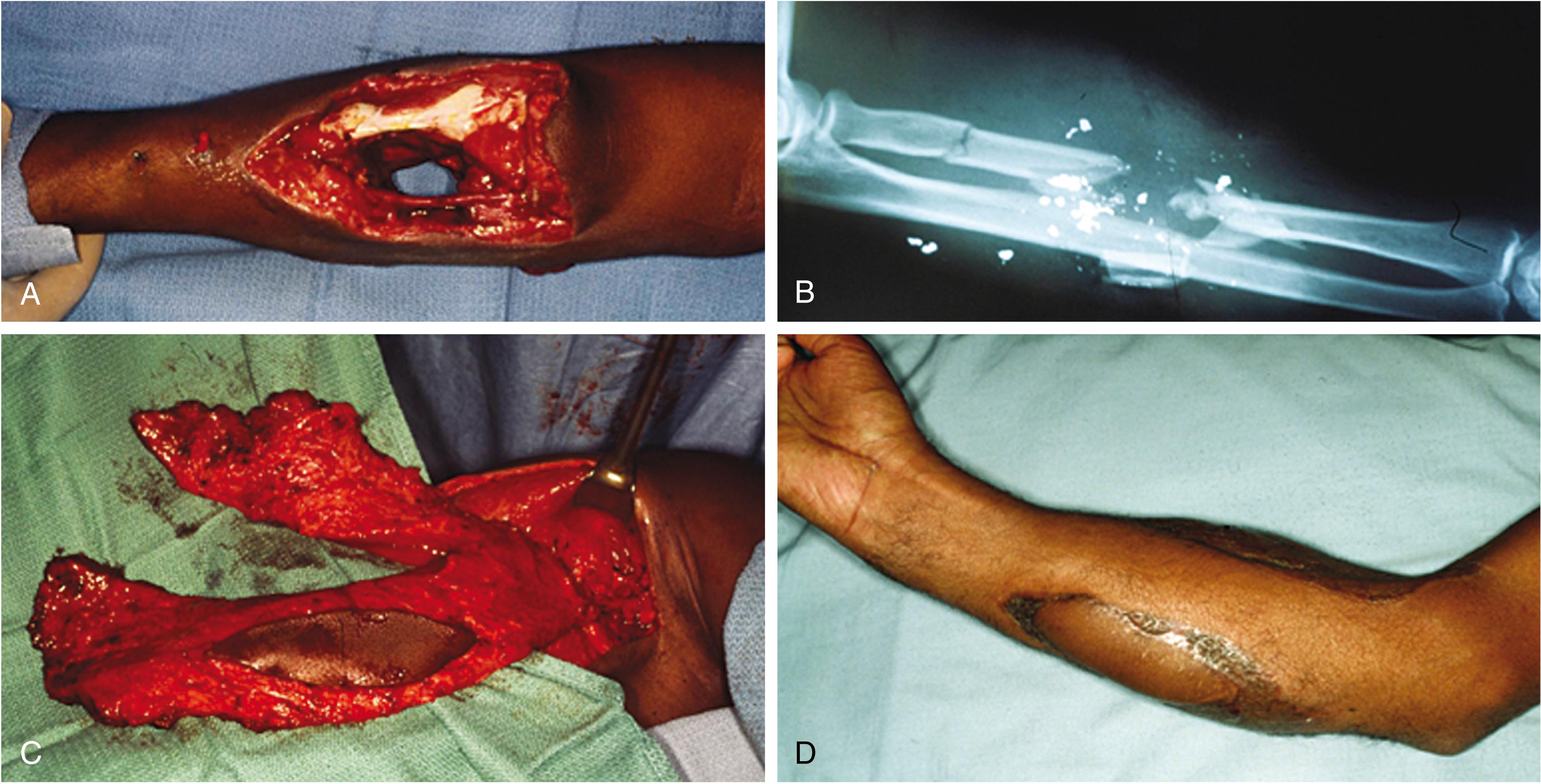 Fig. 70.13, (A) Gunshot wound of forearm showing extensive soft tissue injury. (B) Initial radiograph. (C) Microvascular reconstruction using a bilobed latissimus dorsi musculocutaneous flap was done in association with fracture fixation. (D) Long-term follow-up of reconstructed forearm that also required sural nerve grafting to a segmental injury of the median nerve.