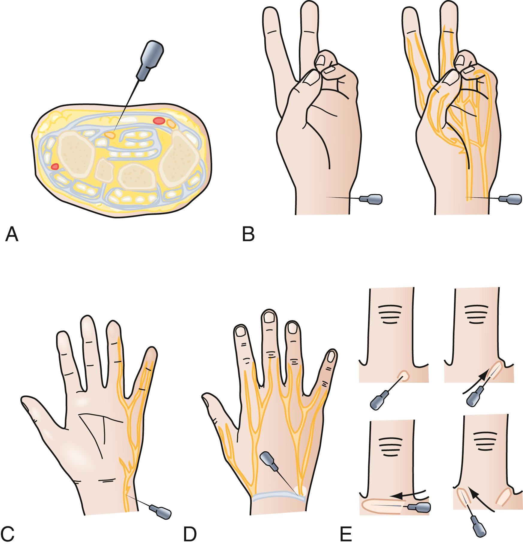 Fig. 70.14, (A) Median nerve block is done at the wrist, where the median nerve is superficial to all the flexor tendons in the carpal tunnel. (B) At the wrist, when a median nerve block is performed, the needle is directed between the palmaris longus and flexor carpi radialis tendons. (C) Ulnar nerve block at the wrist is done by passing the injecting needle around the ulnar deep aspect of the flexor carpi ulnaris tendon just proximal to the pisiform. Intravascular injection into the immediately adjacent ulnar artery is avoided by first aspirating before injection. (D) Dorsal branches of the ulnar nerve and superficial sensory radial nerve are anesthetized by raising a broad weal of local anesthetic across the dorsum of the wrist. (E) A dorsal approach to the finger can be used for digital nerve block.