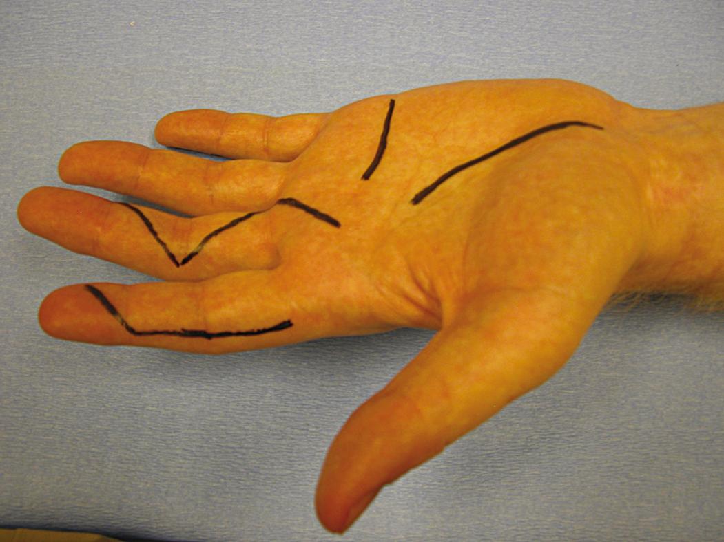 Fig. 70.15, Incisions used on the palmar surface of the hand must respect the creases. These may be zigzag Bruner incisions or midaxial incisions of the digits.
