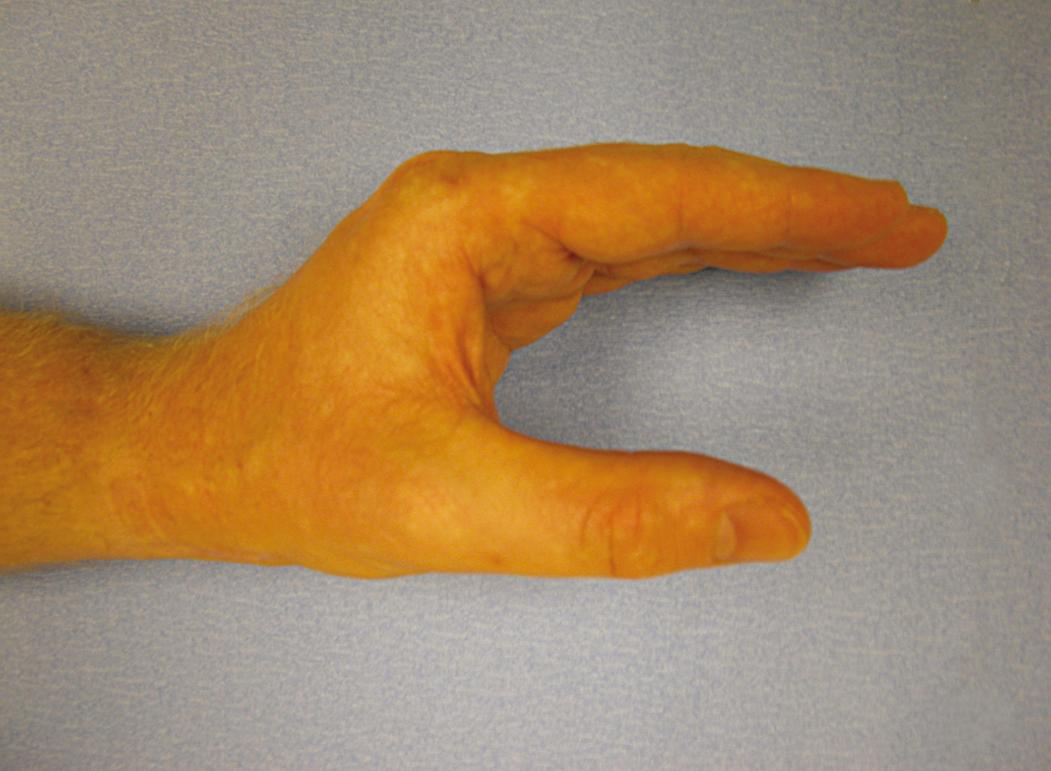 Fig. 70.16, The safe or protected position of the wrist, hand, and digits for application of a splint and dressings. The thumb is palmar abducted.