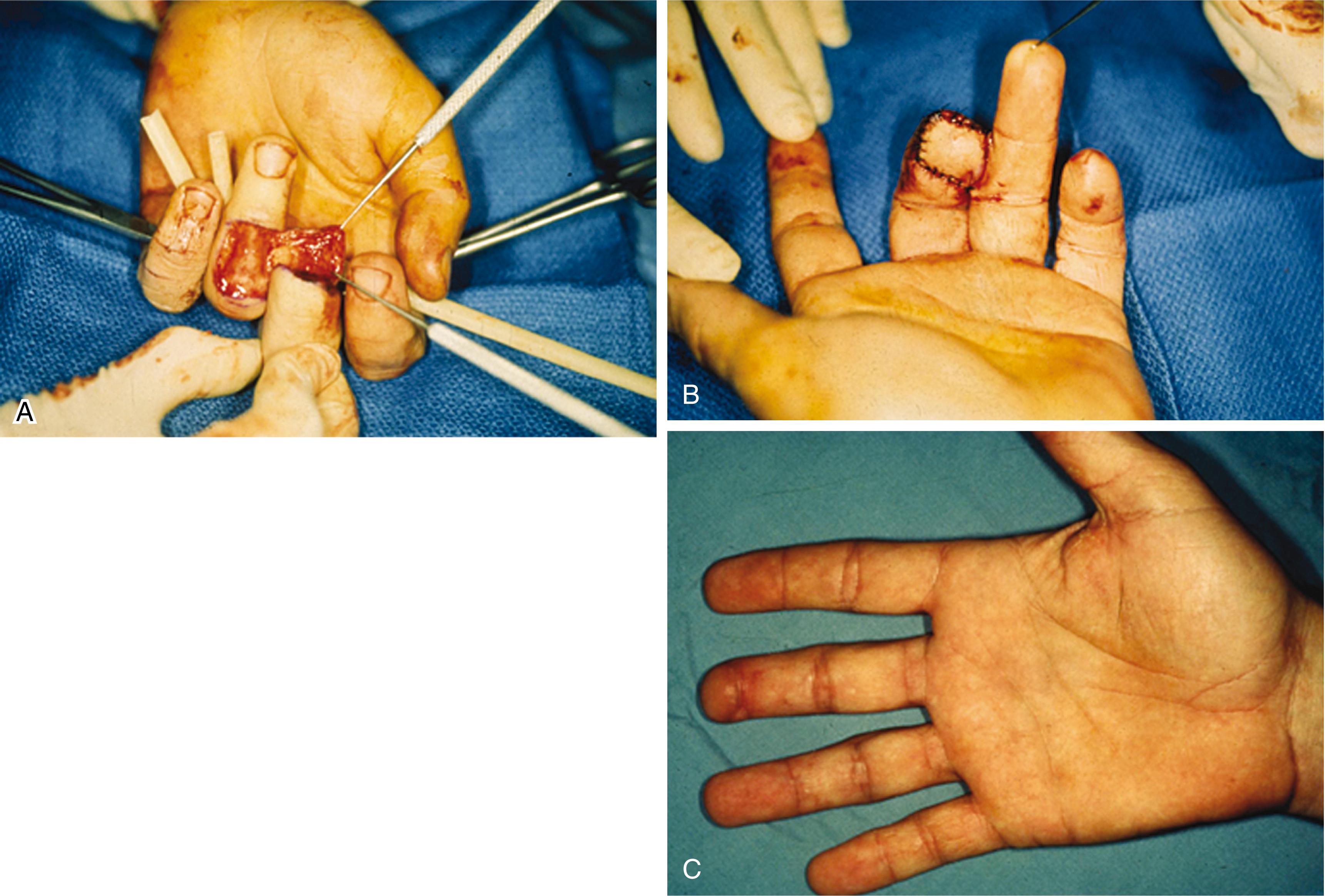 Fig. 70.17, (A and B) Volar angulated fingertip injury with loss of pulp pad and bone exposed was treated with a traditional cross-finger flap from the dorsum of the adjacent finger. (C) Excellent healing is seen in the long term after flap division.