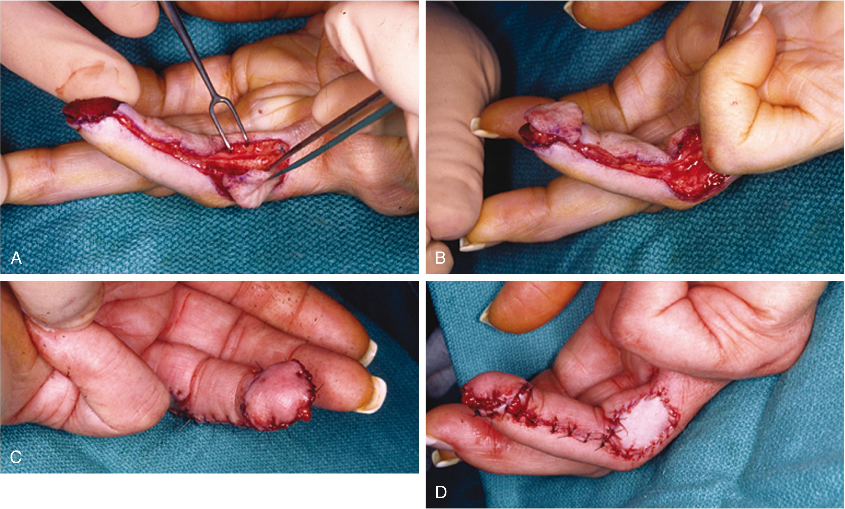 Fig. 70.18, (A–D) More recent understanding of the vascular skin territories of the finger and hand enables intrinsic flap coverage of fingertip injuries and avoids the cumbersome tethering of adjacent fingers, as is done with cross-finger flaps. In this patient, a distally based turnover vascular island flap reconstructs an avulsed fingertip. The reverse-flow perforating vessels at the proximal interphalangeal joint cross from the opposite side to nourish this flap.