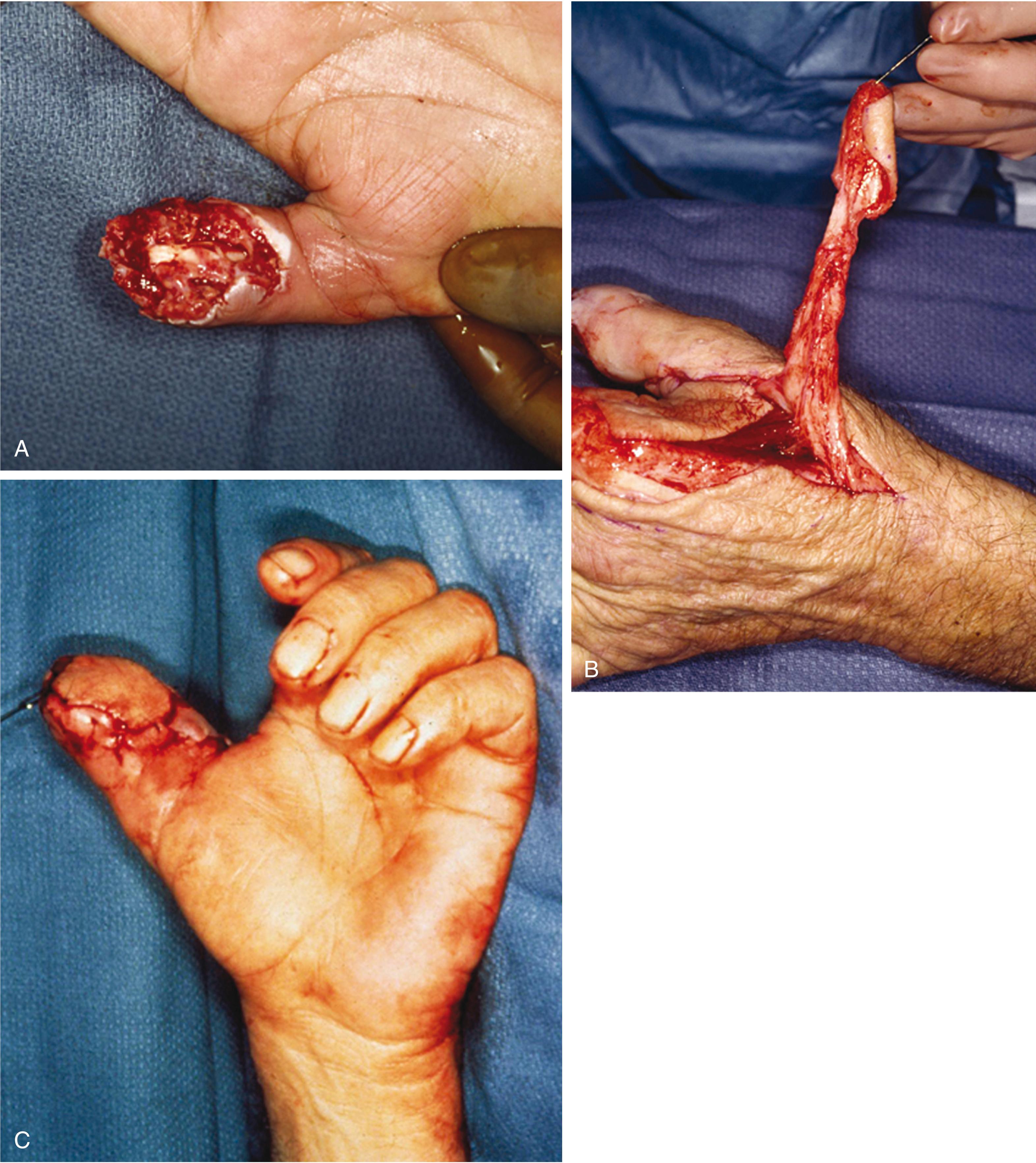 Fig. 70.19, (A–C) The first dorsal metacarpal artery flap is a vascularized island flap that is transposed from the dorsoradial aspect of the index finger to the distal pulp of the thumb after a crushing injury.