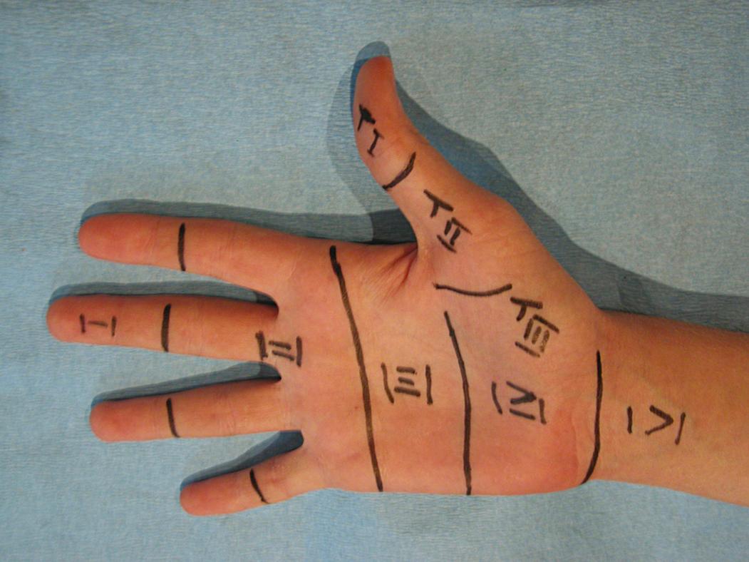 Fig. 70.20, Zones of flexor tendon injuries on the fingers, thumb, and hand.
