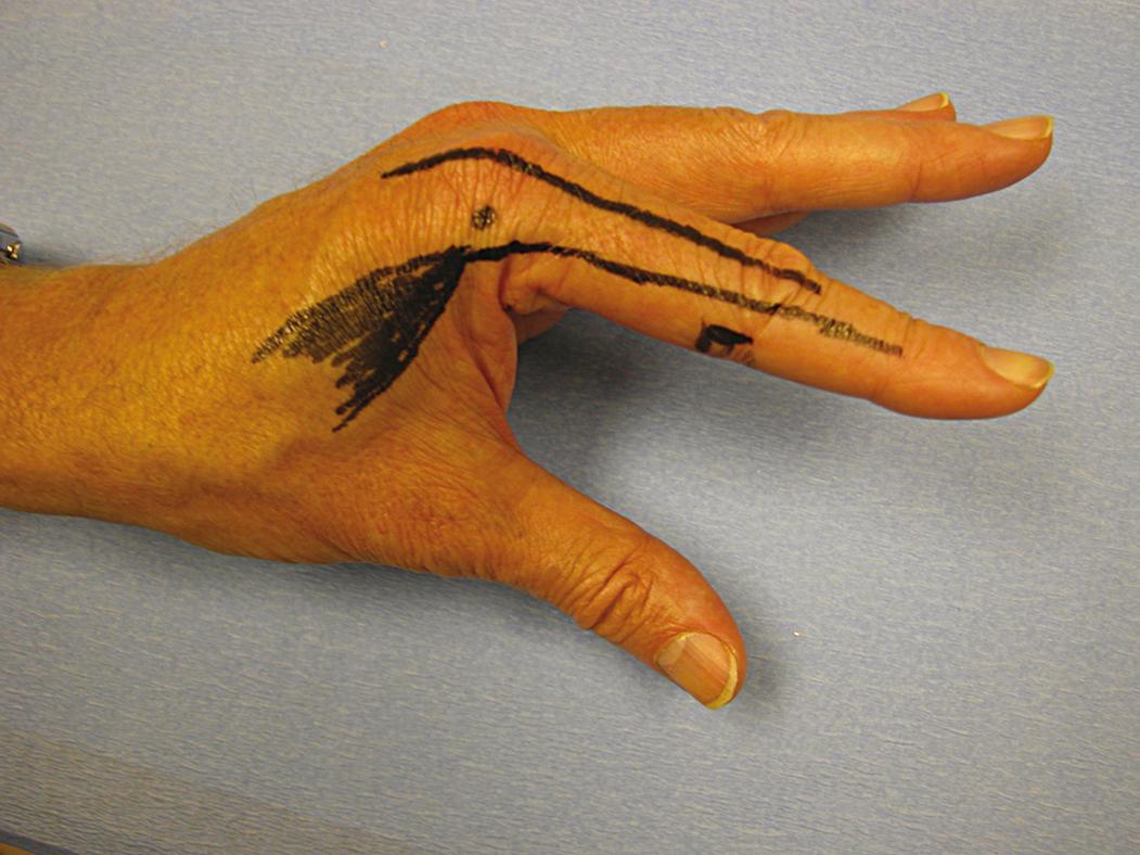 Fig. 70.2, Outline of first dorsal interosseous muscle on the index finger shows how it passes volar to the fulcrum of flexion of the metacarpophalangeal joint and dorsal to the interphalangeal joints. Interossei flex metacarpophalangeal joints and extend proximal and distal interphalangeal joints. The long extrinsic extensor tendon passes dorsal to all joints.