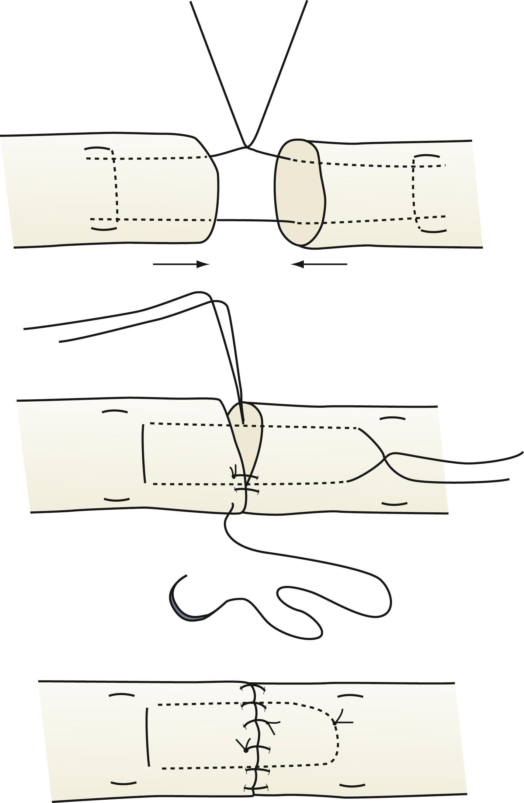 Fig. 70.22, Technique of performing a four-strand flexor tendon core suture repair is demonstrated in association with a peripheral running suture.