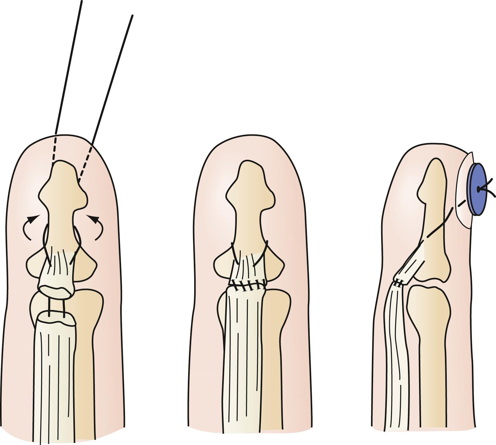 Fig. 70.23, Zone 1 flexor tendon repair to reattach tendon to bone.
