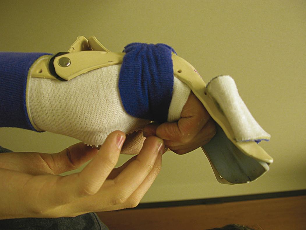 Fig. 70.24, Flexor hinge brace with place-and-hold technique of finger mobilization is one of the preferred methods for postoperative rehabilitation after flexor tendon repair.