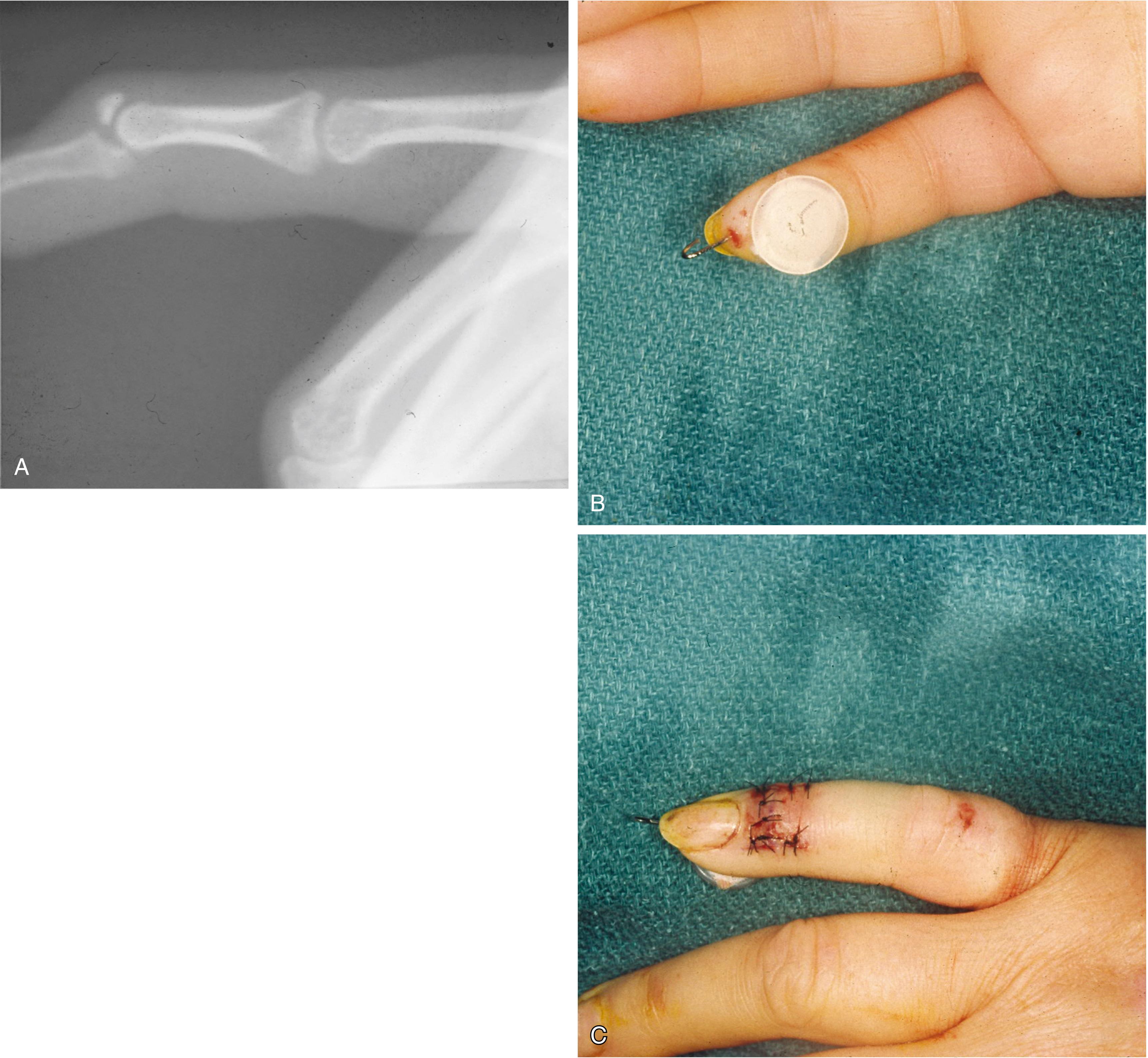 Fig. 70.25, (A–C) Mallet fracture with avulsed bone fragment involving more than 50% of the articular surface with volar subluxation of the distal phalanx. The bone fragment is reapproximated with a tie-over volar suture and a longitudinal pin traversing the distal interphalangeal joint.