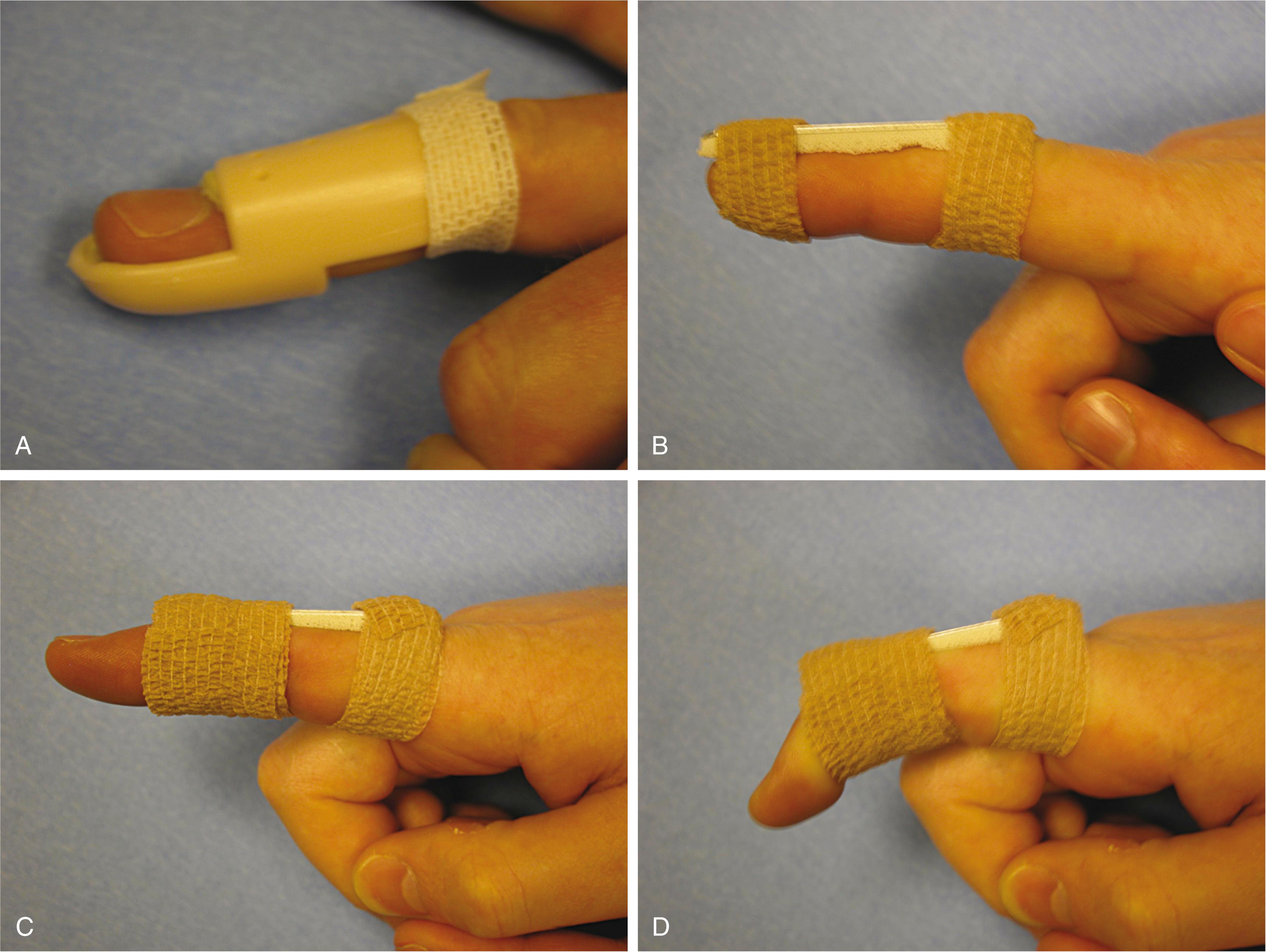 Fig. 70.26, (A) Prefabricated stack splint may be used for the closed treatment of a mallet finger. (B) A simple dorsal aluminum splint may serve equally well for mallet finger treatment. (C and D) Dorsal splinting across the proximal interphalangeal joint enables closed treatment of a boutonnière injury. The distal interphalangeal joint is left free for flexion and extension.