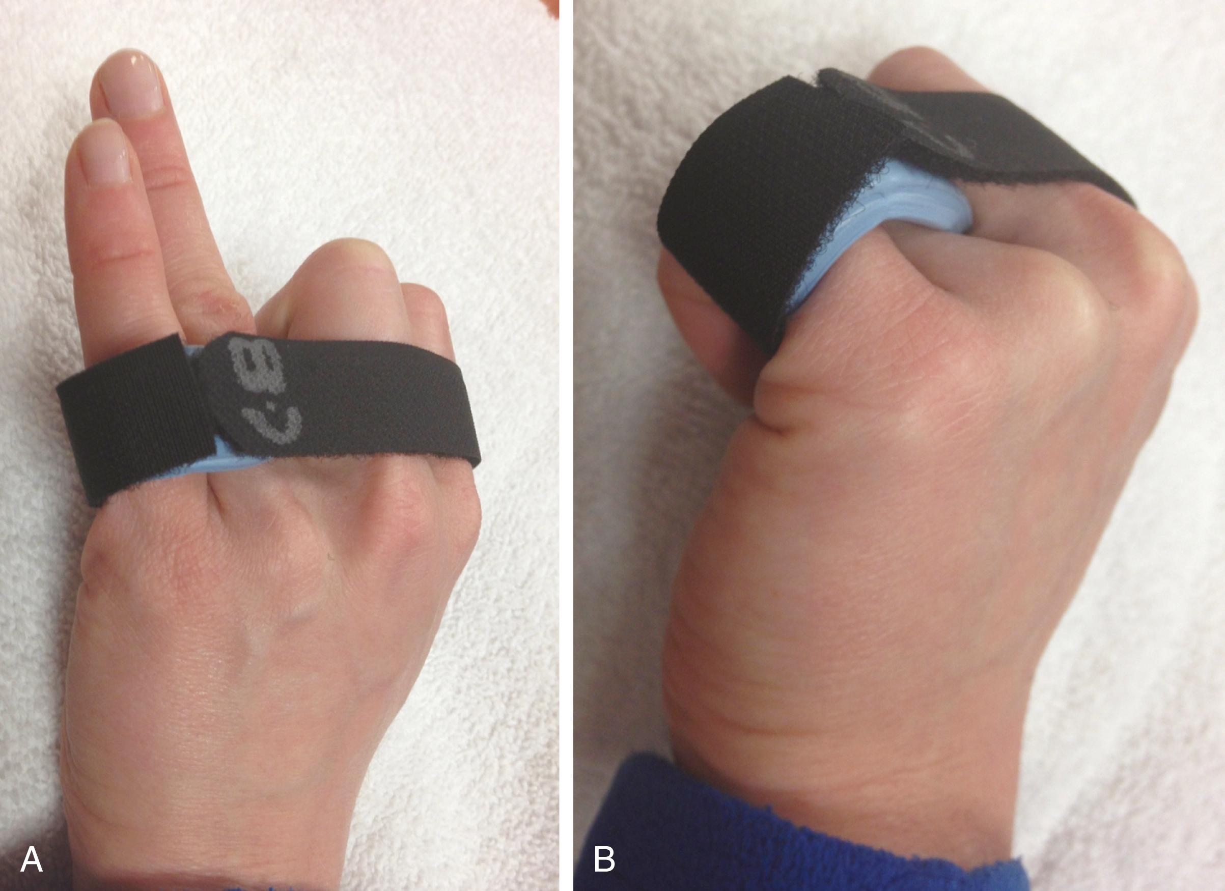 Fig. 70.27, (A and B) Relative motion splint can also be used to “depress” and to block extension of the proximal phalanx of a digit affected by boutonnière deformity. This encourages dorsal repositioning of the lateral bands over the dorsum of the proximal interphalangeal joint.