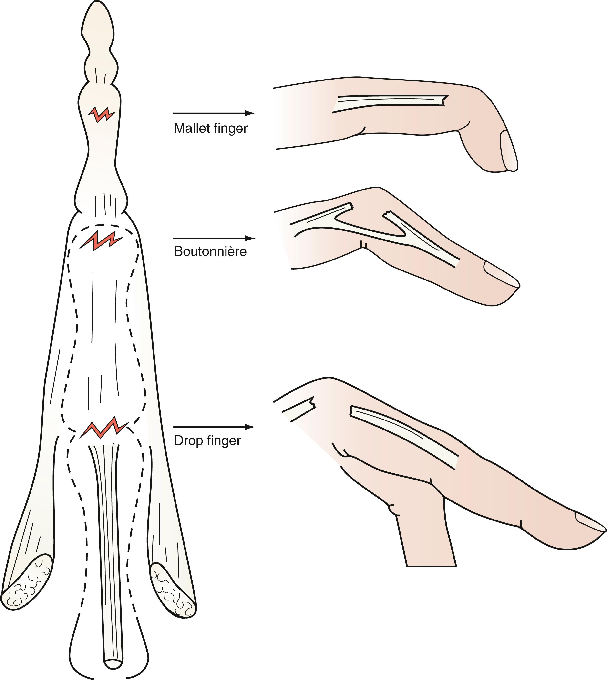 Fig. 70.28, Extensor tendon injuries on the dorsum of the finger. Injury at the distal insertion causes a mallet finger, and injury at the central slip over the proximal interphalangeal joint causes a boutonnière deformity. Proximal to the proximal interphalangeal joint, over the proximal phalanx, injury results in a drop finger.