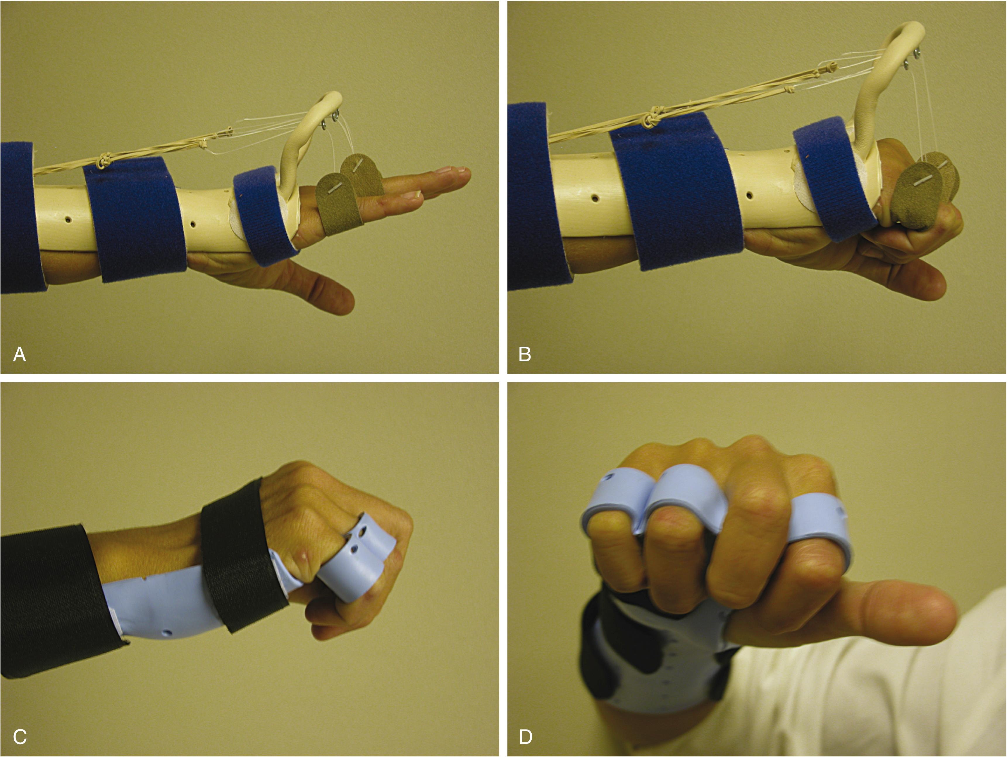 Fig. 70.29, (A and B) Extension outrigger dynamic splint commonly used for extensor tendon injuries postoperatively (extension and flexion views). (C and D) Relative motion splint has the advantage of being low profile and causes minimal interference with daily activities and yet provides protection to the freshly repaired extensor tendon.