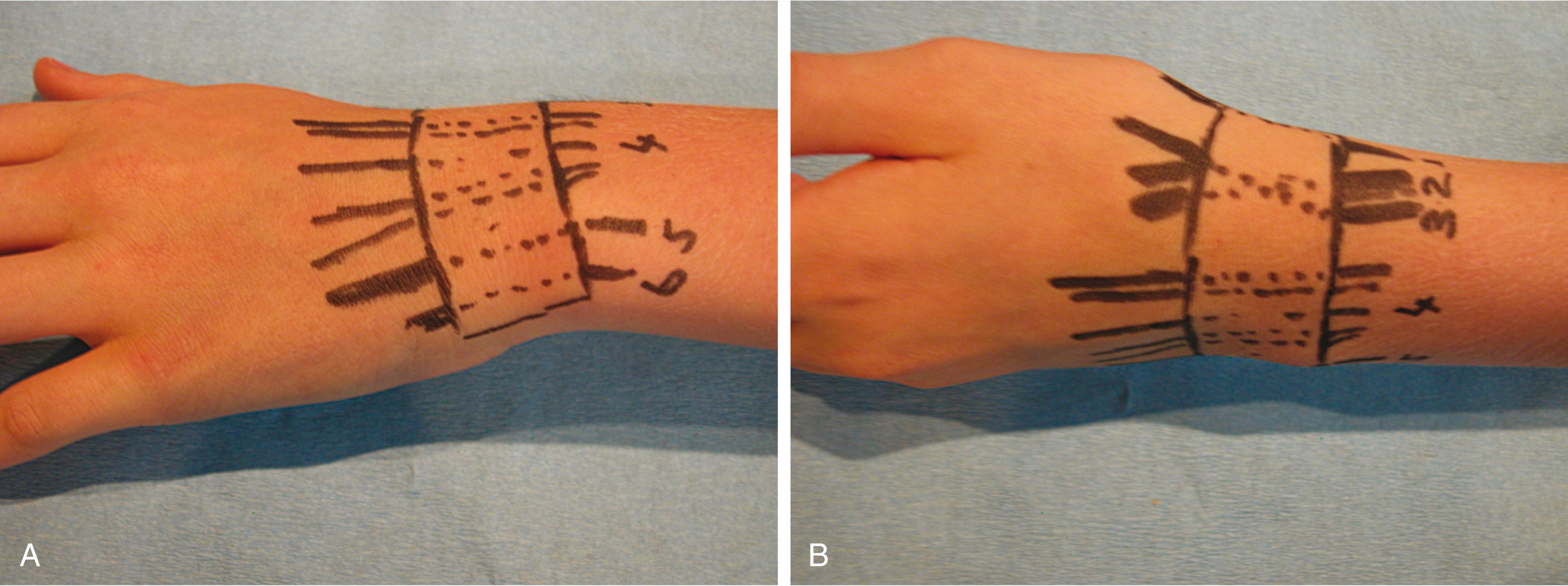 Fig. 70.3, (A and B) Surface anatomy of the six dorsal extensor compartments at the wrist. Note that the first (abductor pollicis longus and extensor pollicis brevis) and third (extensor pollicis longus) compartments form the radial and ulnar boundaries, respectively, of the anatomic snuffbox.