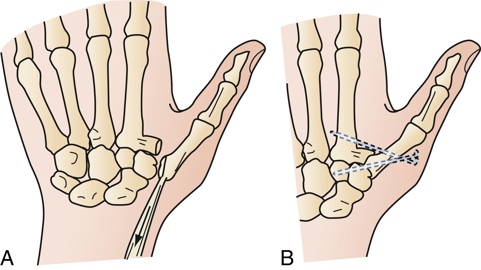 Fig. 70.31, (A) Fracture-dislocation at the base of the thumb metacarpal is called Bennett fracture. The deforming force is produced by the pull of the abductor pollicis longus muscle. (B) Open reduction and pinning of the fracture are frequently required.