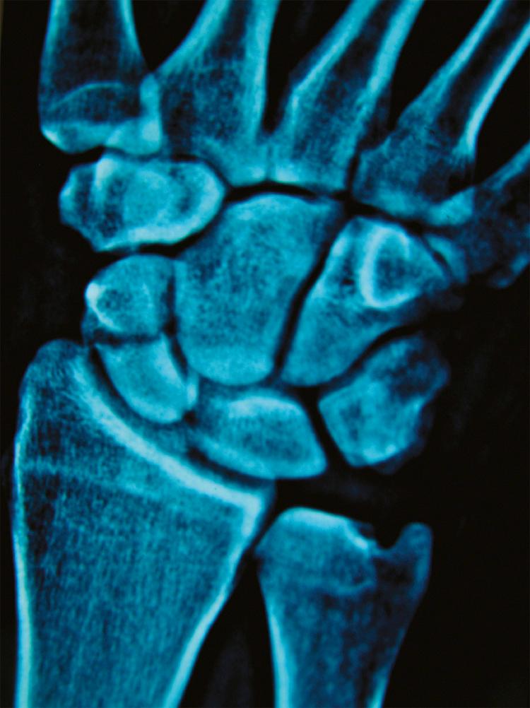 Fig. 70.32, Anteroposterior radiograph of the wrist demonstrating a fracture of the waist of the scaphoid, the bone in the hand that is usually fractured.