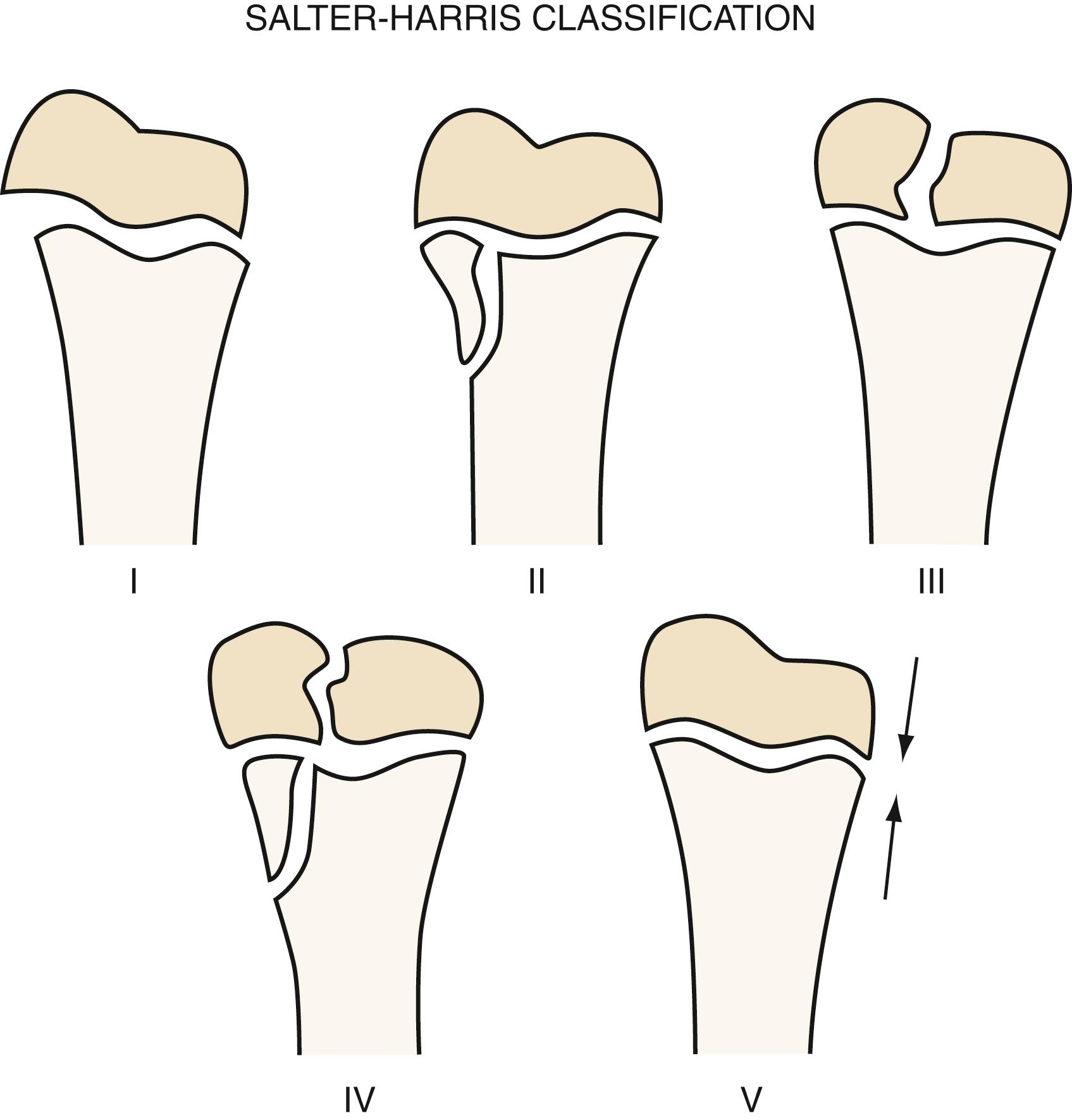 Fig. 70.33, Salter-Harris fracture patterns involving the epiphysis in children.