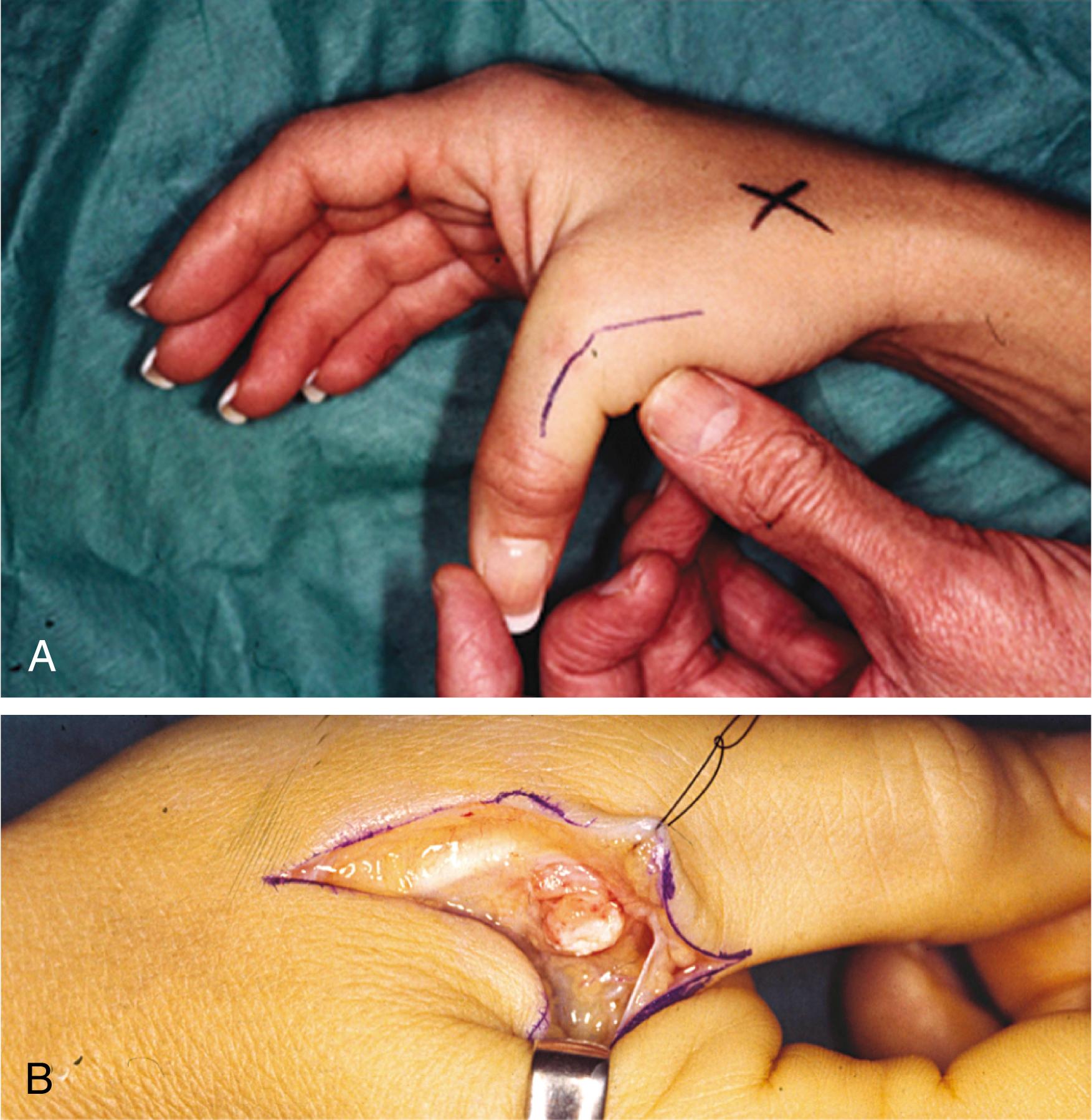 Fig. 70.34, (A) Instability of the ulnar collateral ligament of the metacarpophalangeal joint of the thumb. (B) Stener lesion shows that the distal insertion of the collateral ligament has avulsed proximal to the extensor hood and is thus blocked from spontaneous reattachment. Open operation is required to reanchor the collateral ligament insertion to the base of the proximal phalanx.