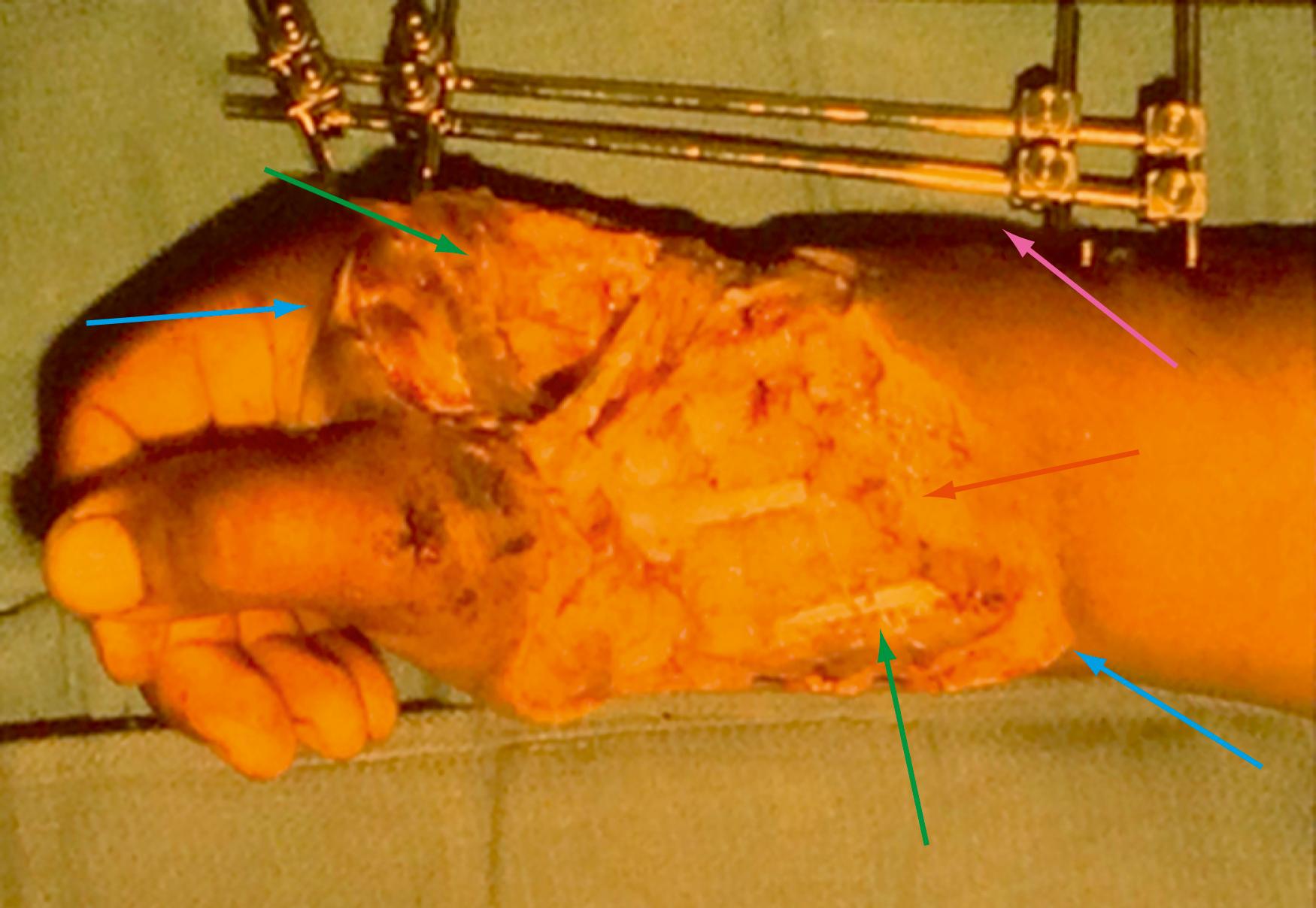 Fig. 70.35, Treatment of the mangled extremity should progress in a stepwise manner.