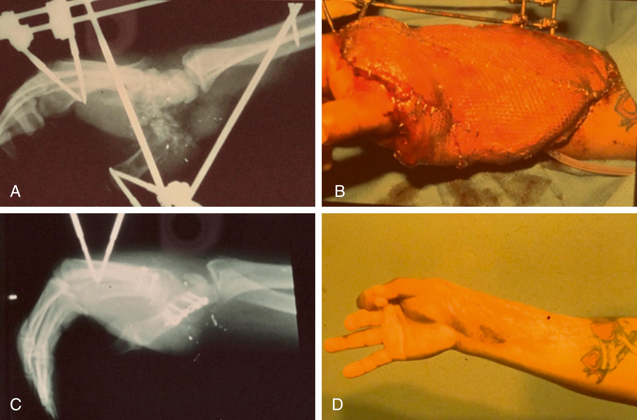 Fig. 70.36, Stepwise approach to injury from Fig. 70.35 . Top left: initial temporary fixation and revascularization of the thumb. Top right: definitive soft tissue coverage with flap and skin graft. Bottom left: definitive bony fixation. Bottom right: 1-year results after tendon transfers and never recover.