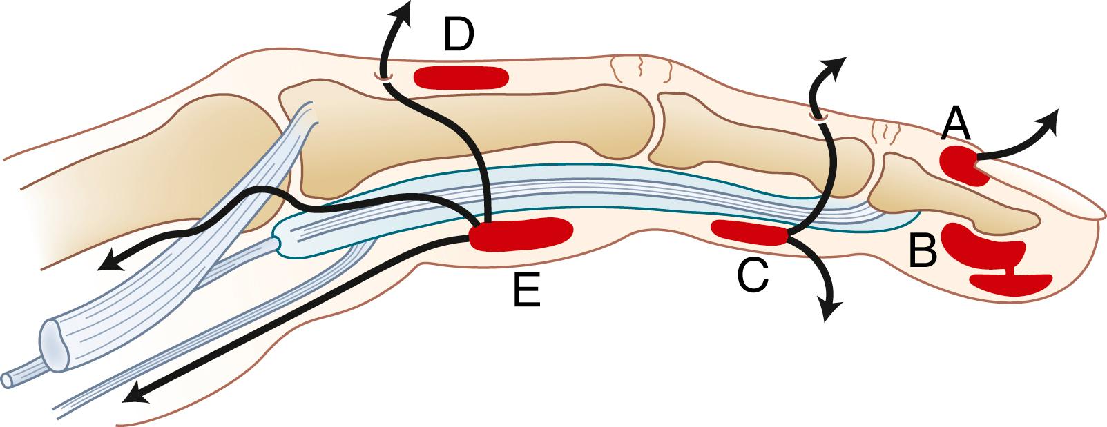 Fig. 70.37, Spread of soft tissue infections in the hand occurs through loss of containment from the original site and erosion into and spread through contiguous anatomic compartments. A, Paronychium. Infecting organisms access periungual tissues through fissures in the eponychial or paronychial tissues and often are discharged spontaneously in these areas. B, Infection of pulp tissues (felon). Fibrous septa within the pulp create collar stud abscesses within the pulp. C, Volar subcutaneous infections in the digit may be discharged percutaneously on either surface of the digit or penetrate dorsally and spread along the sheaths of the flexor or extensor tendons. D, Subcutaneous infections on the dorsum of the digit are usually discharged percutaneously because of the thin and areolar nature of the soft tissues. E, Proximally located digital infections or web space infections may rupture into the palmar spaces by tracking along tendon sheaths, palmar fascia, or lumbrical canal. The continuous sheaths of the thumb and little fingers (radial and ulnar bursae) are continuous with the carpal tunnel and space of Parona at the wrist.