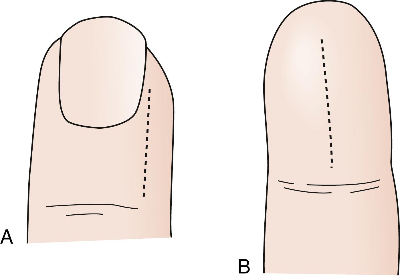 Fig. 70.38, Incisions for paronychia (A) and felon (B).