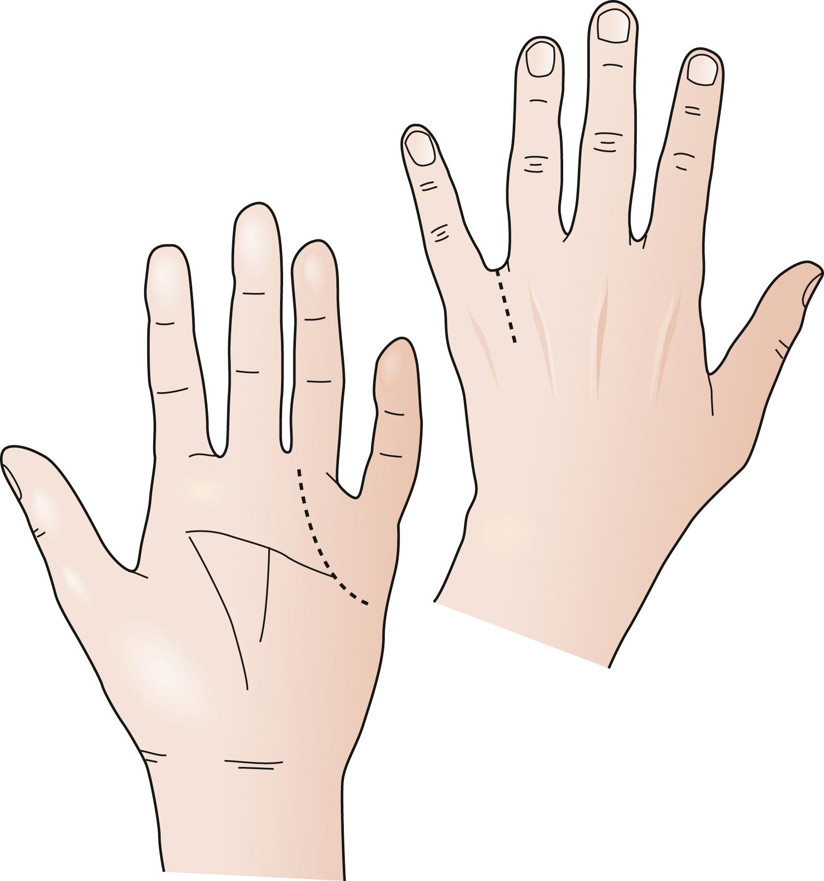 Fig. 70.39, Incisions for web space abscess between the little and ring fingers.