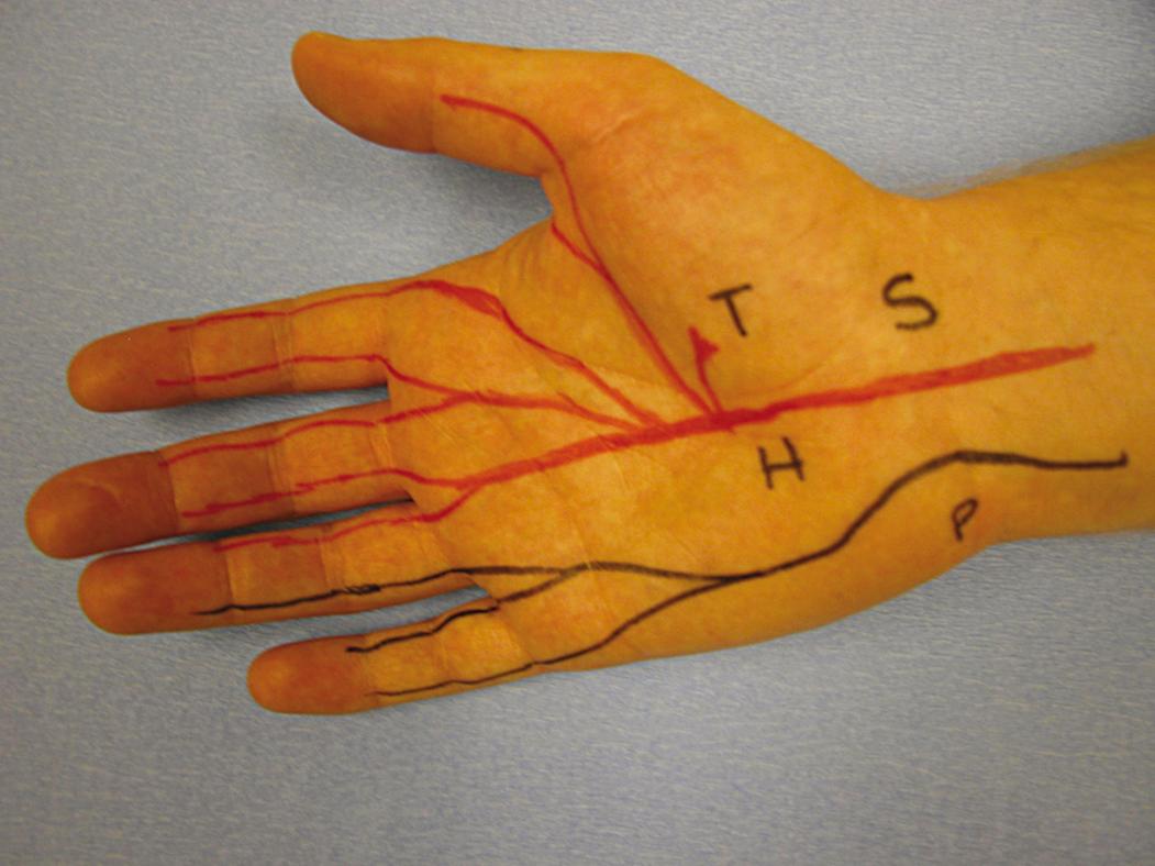 Fig. 70.5, Surface anatomy of median (red) and ulnar (black) nerves. H, Hook of hamate; P, pisiform; S, scaphoid; T, trapezium.