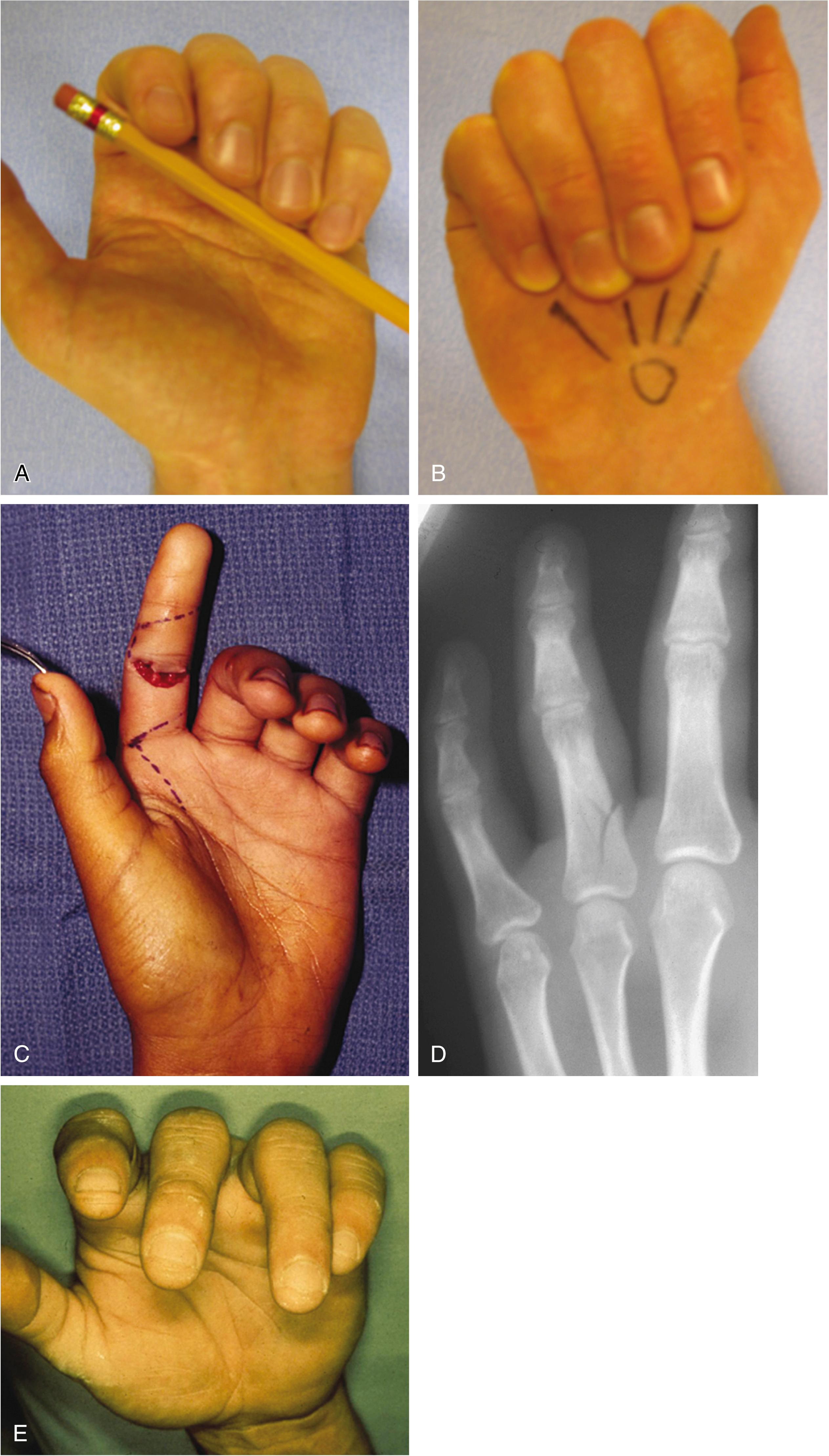 Fig. 70.7, (A and B) Natural finger flexion cascade of the hand in repose. Note the fingertips pointing to the distal pole of the scaphoid. (C) With flexor tendon injury, the affected digit does not adopt this resting flexed posture. (D and E) Spiral finger fractures produce a rotational deformity, which is also noted as an interruption in the finger flexion cascade.