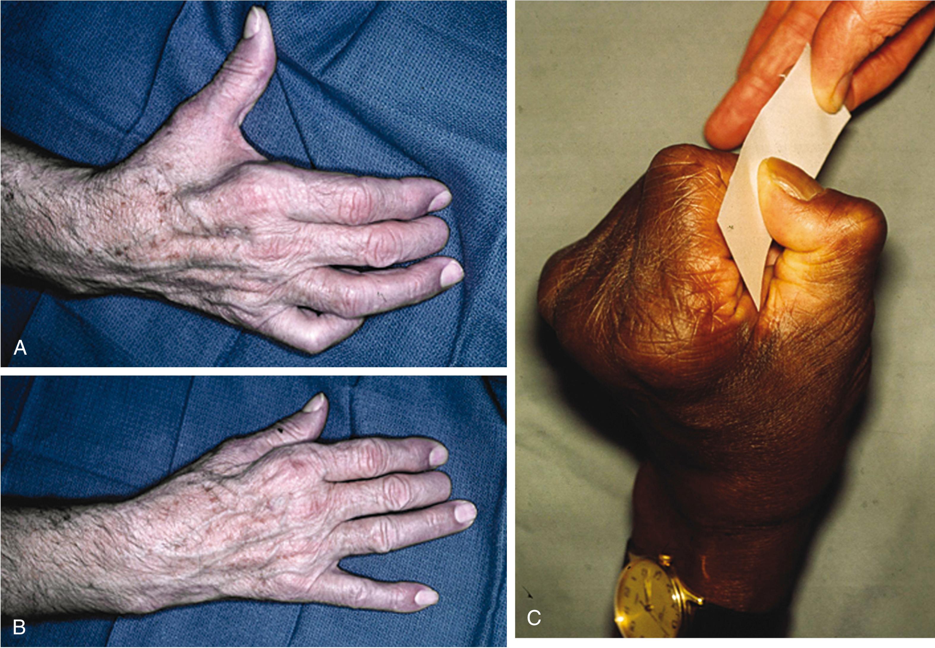 Fig. 70.8, (A) Marked atrophy in the first web space dorsal interosseous muscle is noted with ulnar nerve palsy, with clawing of the little and ring fingers. (B) The little finger assumes an abducted position and cannot be adducted to the adjacent fingers (Wartenberg sign). (C) Because thumb adduction is weak, attempts to grasp a piece of paper between the adducted thumb and index finger produce compensatory thumb interphalangeal joint flexion (Froment sign).