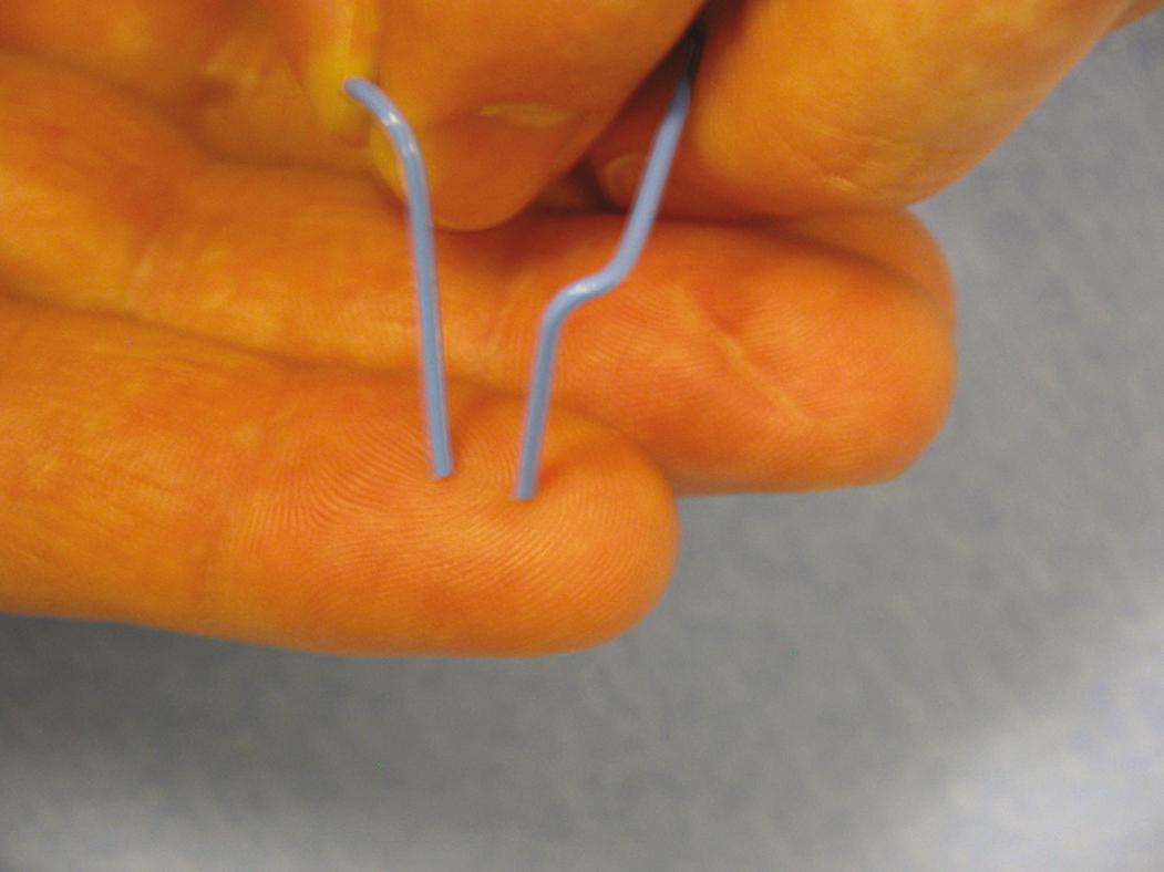 Fig. 70.9, Two-point discrimination on the fingertip can be tested with a bent paperclip, with the tips of the paperclip set specific distances apart.