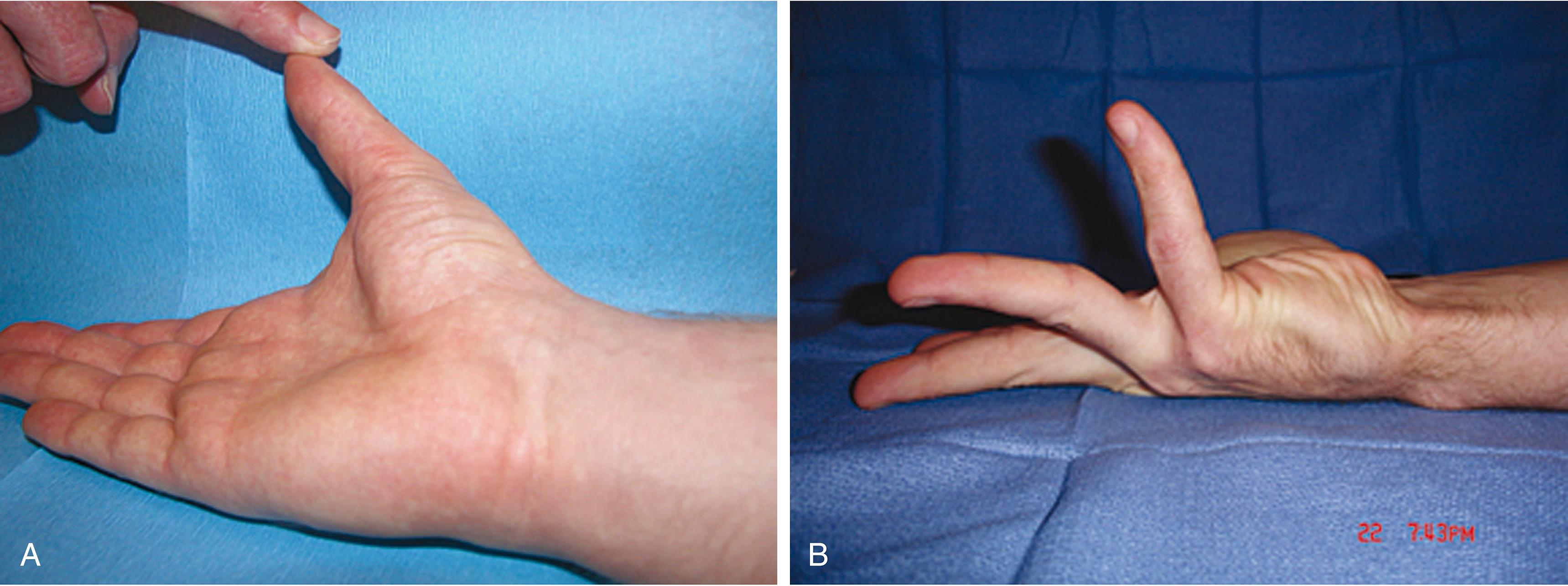 Fig. 70.10, Motor innervation of muscles of the hand. (A) Thumb abduction tests median motor nerve function. (B) Little finger flexion at the metacarpophalangeal joint with simultaneous interphalangeal joint extension tests ulnar motor nerve function.