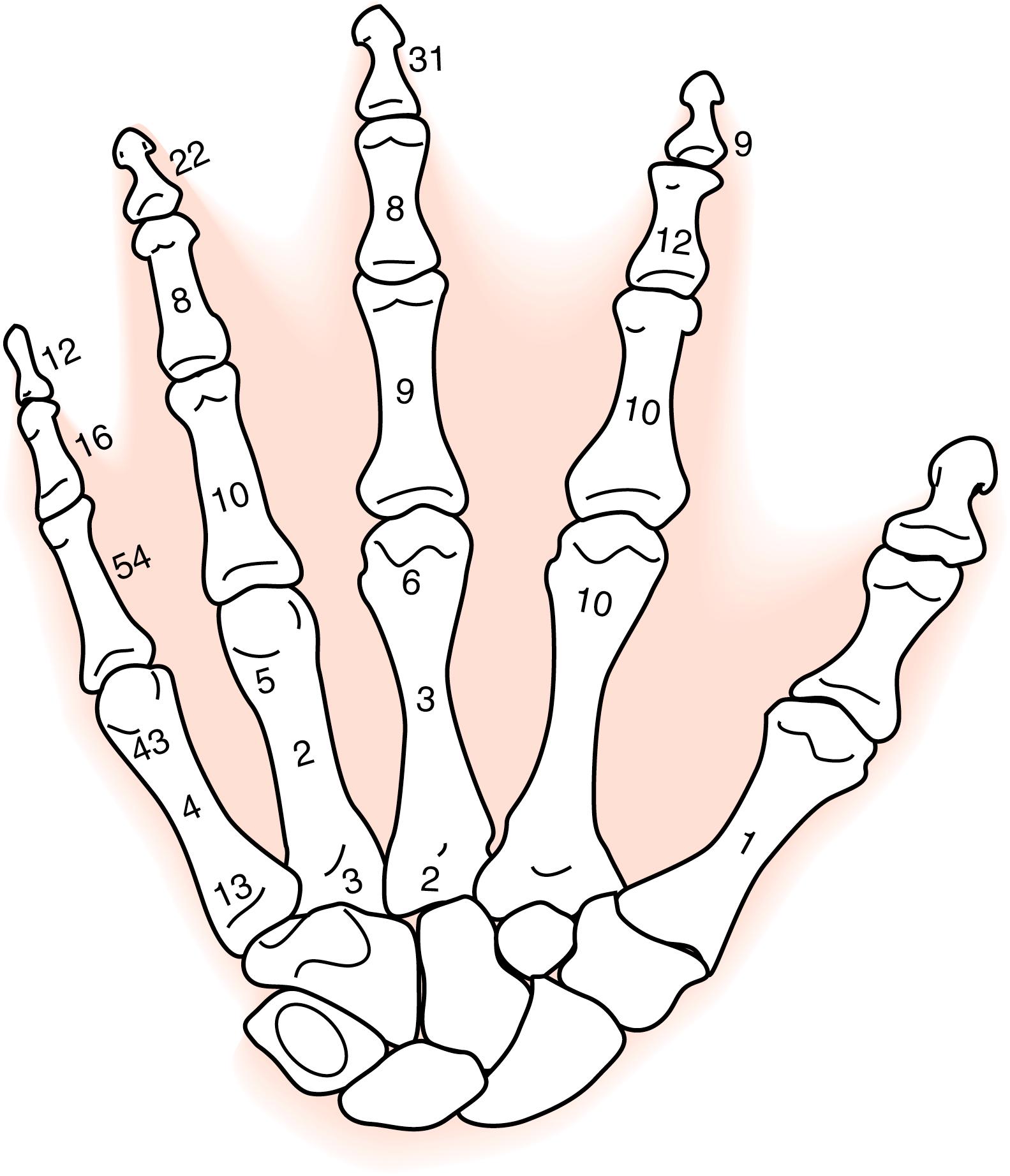 Fig. 41.1, Schematic diagram depicting the distribution of hand fractures in 280 children younger than 16 years.