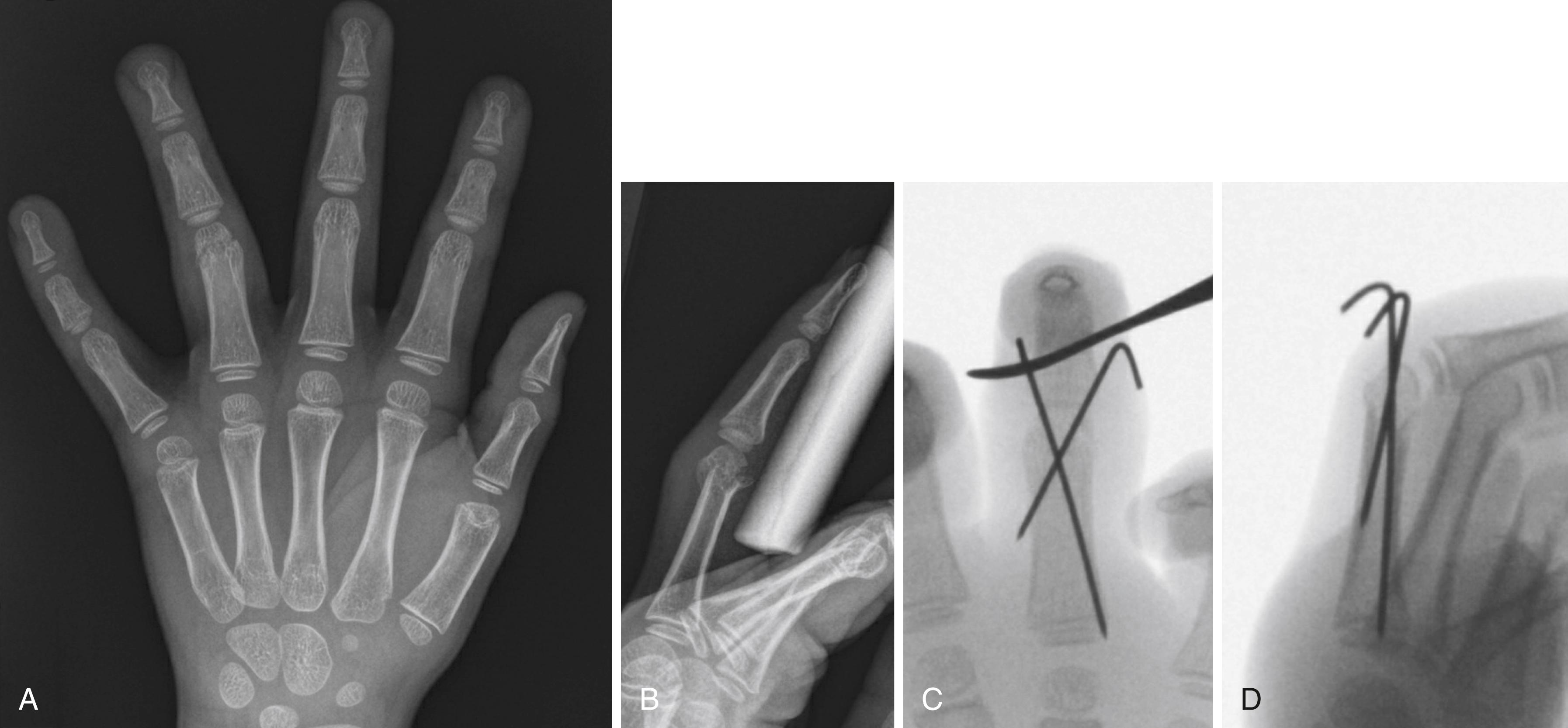 Fig. 41.11, AP (A) and lateral (B) radiographs of a displaced proximal phalangeal neck fracture of the ring finger. The radiographic findings are subtle on the AP projection, but dorsal displacement is clearly seen on the lateral. C and D, Intraoperative radiographs following closed reduction and percutaneous pin fixation. Note reconstitution of the concave subcondylar fossa, restoring interphalangeal joint flexion.