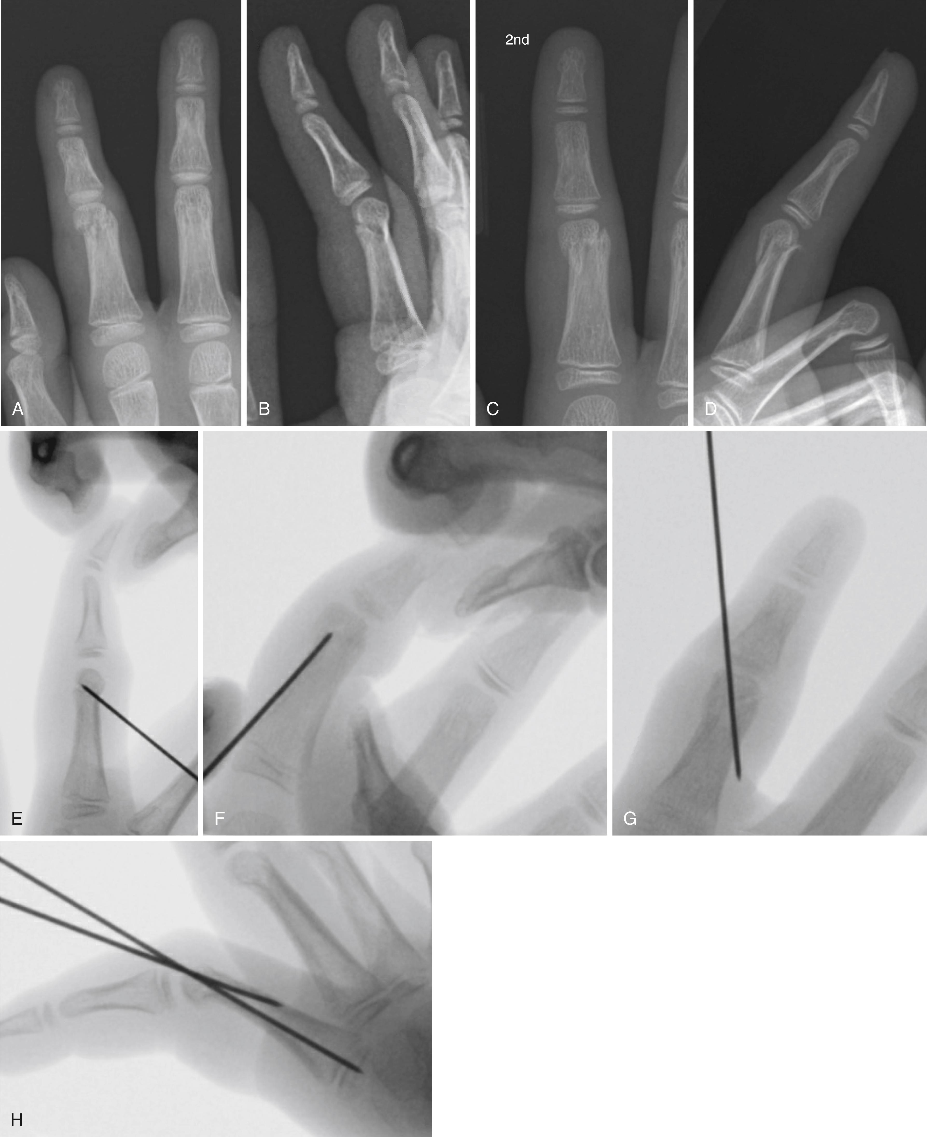 Fig. 41.12, AP (A) and lateral (B) radiographs demonstrating a minimally displaced phalangeal neck fracture on the day of injury. At the first orthopedic follow-up 2 weeks later, there is further displacement, as seen on the AP (C) and lateral (D) radiographs. Intraoperative radiographs ( E and F ) demonstrating insertion of a smooth Kirschner wire into the fracture site for osteoclasis and reduction. AP (G) and lateral (H) radiographs demonstrating reduction.