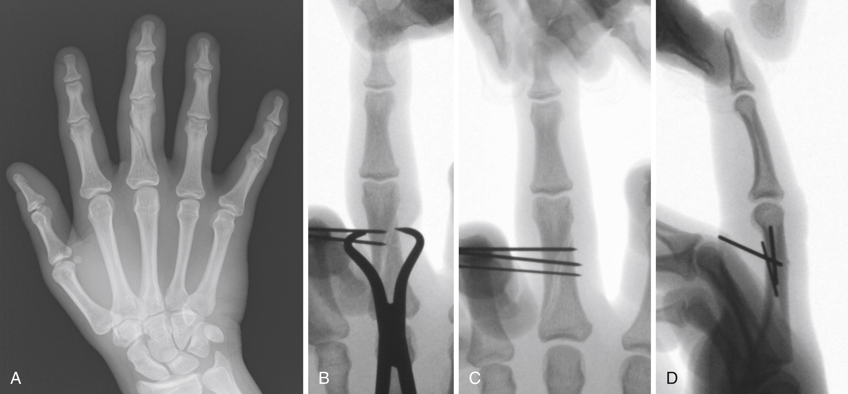 Fig. 41.13, A, AP hand radiograph of a displaced phalangeal diaphyseal fracture demonstrating malrotation of the long finger. B, A point-to-point reduction clamp can help align the fracture. AP (C) and lateral (D) intraoperative radiographs demonstrating final fixation and alignment.