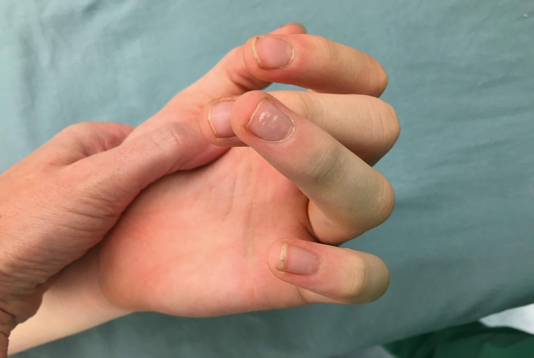 Fig. 41.2, Clinical photograph demonstrating rotational deformity of the ring finger in the setting of a proximal phalanx fracture.