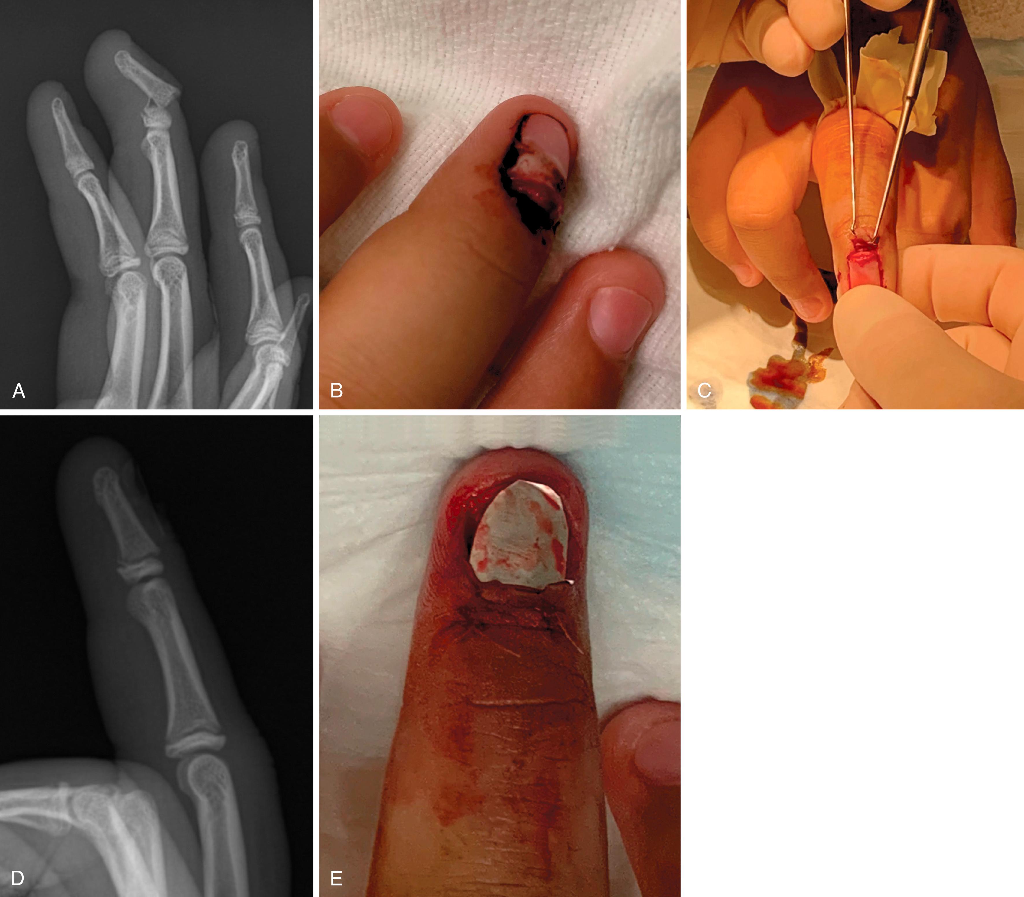 Fig. 41.6, A, Lateral radiograph depicting a displaced physeal fracture of the distal phalanx with an associated nail bed laceration, the so-called Seymour fracture. B, Clinical picture of the nail plate resting superficial to the eponychium, demonstrating the open nature of this injury. C, Clinical photograph of procedure in the emergency department with elevation of the dorsal nail fold. The interposed germinal matrix is extricated, the cartilaginous physis is visualized, and the fracture is reduced, as seen in the lateral radiograph. D and E, The foil from the suture package is placed under the eponychium and the finger is immobilized.