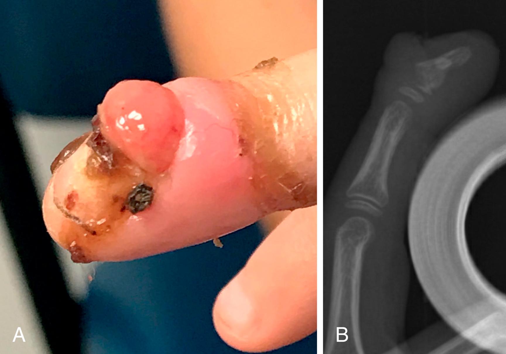 Fig. 41.7, A, Clinical photograph of nail plate deformity following an untreated Seymour fracture. B, Lateral radiograph of the same patient depicting lytic changes in the metaphysis of the distal phalanx associated with chronic osteomyelitis.