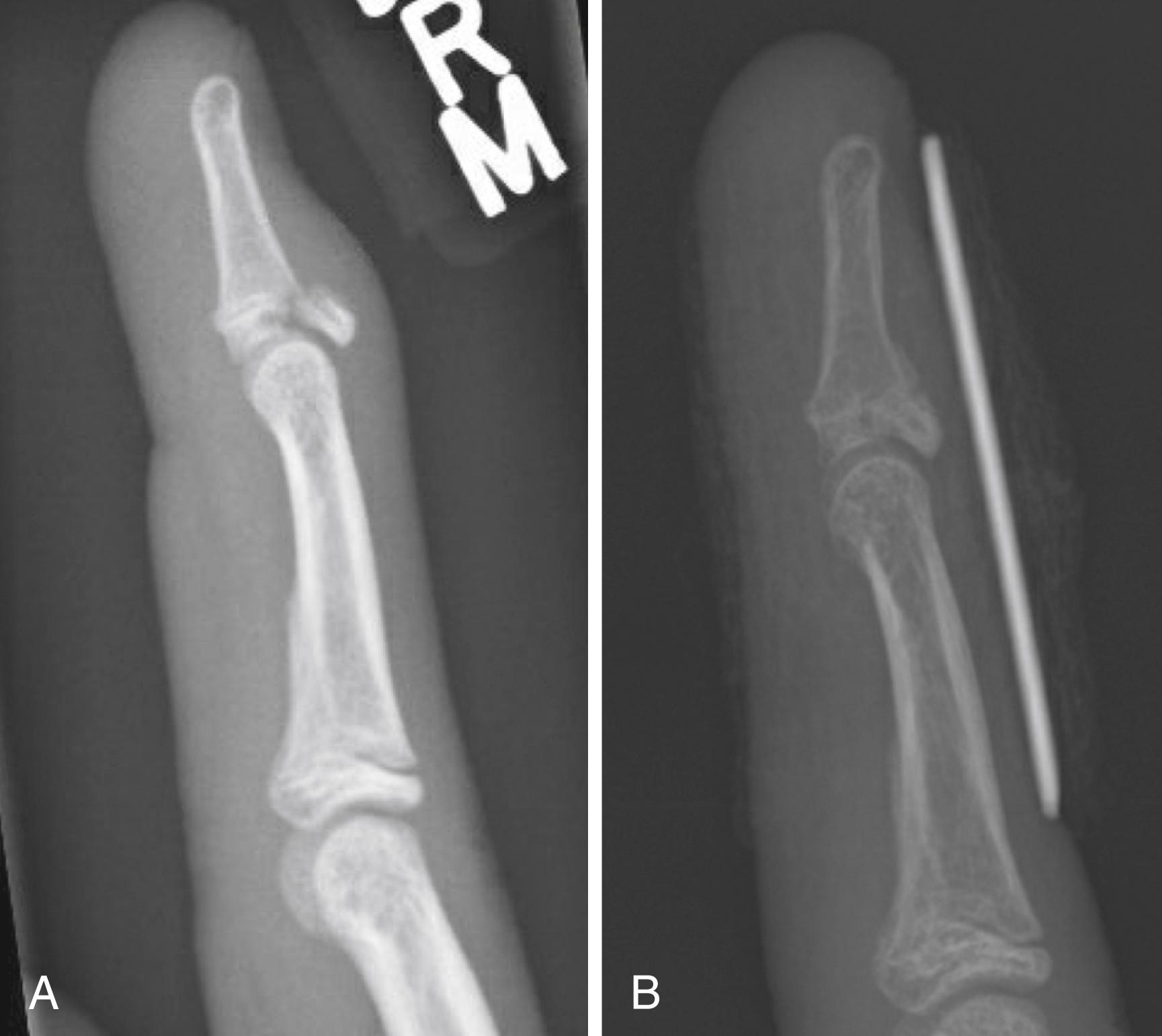 Fig. 41.8, A, Lateral radiograph depicting a Salter-Harris III fracture of the distal phalanx, the pediatric equivalent of the adult bony mallet fracture. B, Callus and remodeling after 6 weeks of full-time splinting.