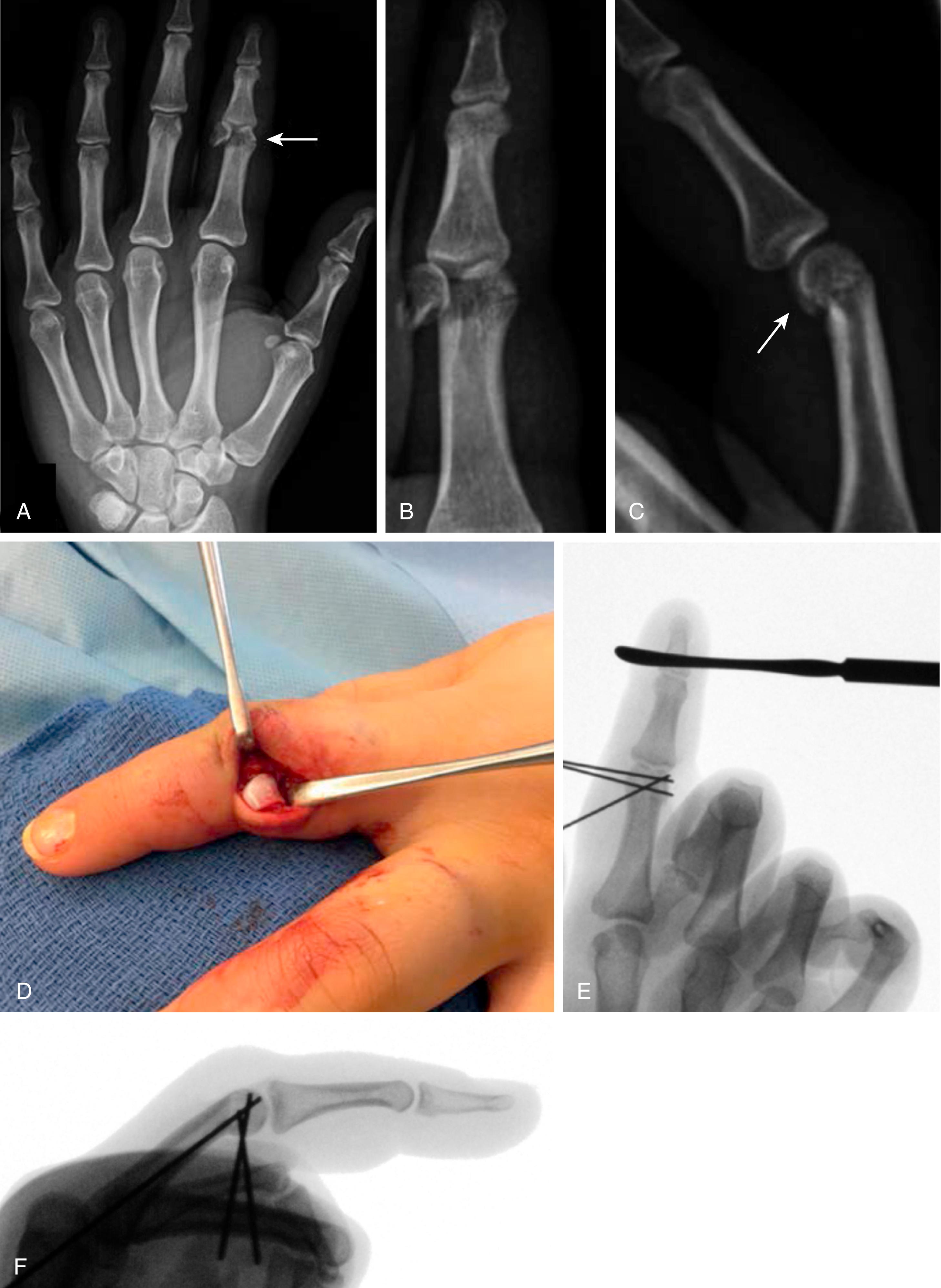 Fig. 41.10, AP (A) , oblique (B) , and lateral (C) radiographs showing a displaced unicondylar fracture of the index finger in a 14-year-old female. D, Intraoperative photograph depicting the incision to exposure the fracture, and complete displacement and 90-degree rotation of the unicondylar fragment. E and F, Intraoperative fluoroscopy after open reduction and pin fixation.