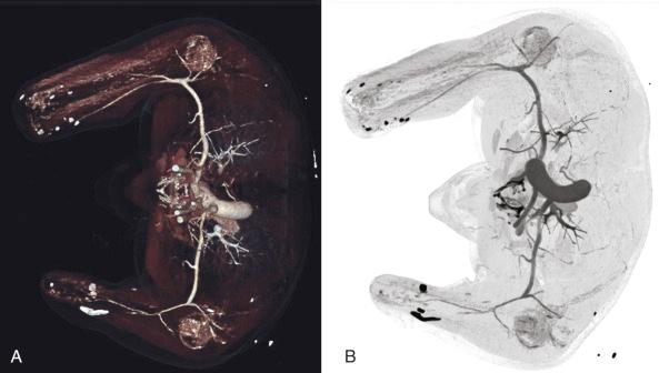 Figure 65.1, (A,B) CT angiography of bilateral upper extremity amputee with shrapnel present demonstrating patency and course of the bilateral brachial arteries with premature termination of both brachial arteries approximately 5 cm proximal to level of amputation.