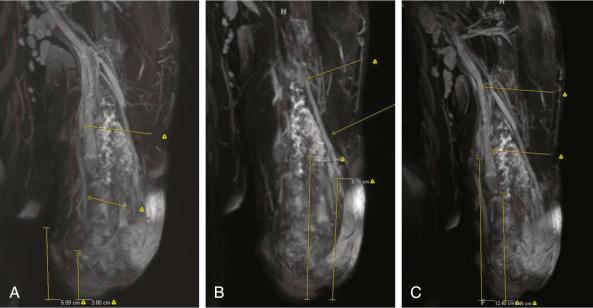 Figure 65.2, MR neurography demonstrating peripheral nerve end neuroma location and length being much more proximal than the level of amputation. (A) Ulnar nerve; (B) radial nerve; (C) median nerve.