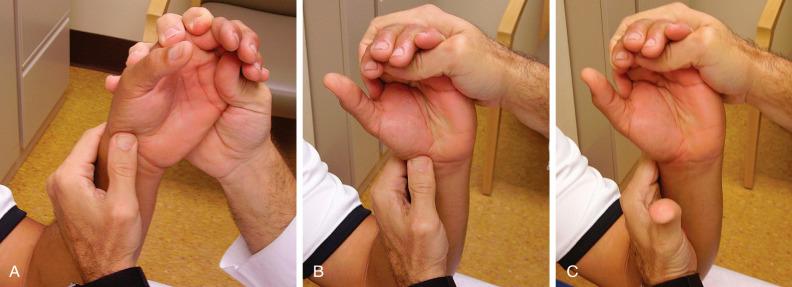 Fig. 67.7, The Watson scaphoid shift test. (A) The examiner places his or her hand with the thumb over the distal pole of the scaphoid and fingers wrapped around the ulnar side of the patient’s hand for stability. (B) The patient’s hand is then passively brought into flexion and radial deviation while dorsal pressure is applied to the scaphoid distal pole, resisting its tendency for volar translation. (C) In a positive test, once the scaphoid is released, it will clunk back into the scaphoid fossa.