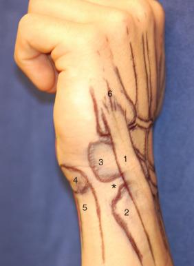 Fig. 67.8, Illustrated surface anatomy of the ulnar quadrant. *, Fovea. 1 , ECU tendon. 2 , Distal ulna and styloid. 3 , Triquetrum. 4 , Pisiform. 5 , FCU tendon. 6 , Base of the fifth metacarpal.