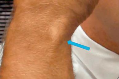 Fig. 67.10, Demonstrates instability of the extensor carpi ulnaris tendon during flexion, ulnar deviation, and supination maneuvers. The blue arrow points to the subluxed extensor carpi ulnaris tendon.