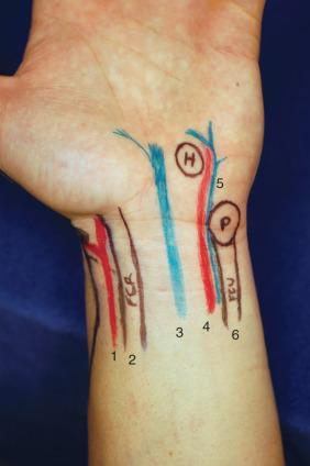 Fig. 67.11, Illustrated surface anatomy of the volar quadrant. 1 , Radial artery. 2 , Flexor carpi radialis tendon. 3 , Median nerve. 4 , Ulnar artery. 5 , Ulnar nerve. 6 , Flexor carpi ulnaris tendon. H, Hamate. P , pisiform.