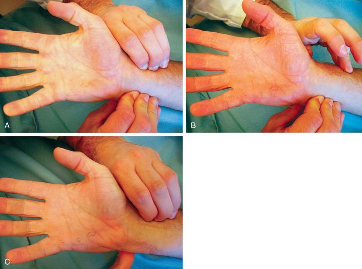 Fig. 67.12, The Allen test to assess the vascular supply of the hand. (A) This test is performed by manually compressing the radial and ulnar arteries, then having the patient open and close his or her fist several times to exsanguinate the hand. (B) Pressure is then released from one of the arteries, which in a normal state (complete superficial palmar arch), should reperfuse the entire hand in less than 3 seconds. (C) The test is then repeated with the release of the other artery, and the resulting flow is documented.