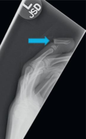 Fig. 67.14, X-ray evaluation demonstrating a displaced transphyseal distal phalanx fracture (blue arrow) , known as a Seymour fracture, which can present with associated nail bed incarceration in the fracture site.