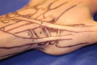 Fig. 67.2, Illustrated surface anatomy of the radial compartment. 1, First dorsal compartment (APL and EPB) and location of pain in De Quervain tenosynovitis. 2 , ECRL next to ECRB as they cross below APL and EPB and location of pain in intersection syndrome. 3 , EPL. 4 , Scaphoid waist in the anatomic snuffbox. 5 , Radial styloid.